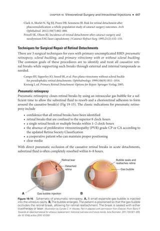 Chapter 19: Vitreoret­
i­
nal Surgery and Intravitreal Injections ● 447
Clark A, Morlet N, Ng JQ, Preen DB, Semmens JB. Risk for ret­
i­
nal detachment ­
after
phacoemulsification: a whole-­
population study of cataract surgery outcomes. Arch
Ophthalmol. 2012;130(7):882–888.
Powell SK, Olson RJ. Incidence of ret­
i­
nal detachment ­
after cataract surgery and
neodymium:YAG ­
laser capsulotomy. J Cataract Refract Surg. 1995;21(2):132–135.
Techniques for Surgical Repair of Ret­
i­
nal Detachments
­
There are 3 surgical techniques for eyes with primary uncomplicated RRD: pneumatic
retinopexy, scleral buckling, and primary vitrectomy with or without scleral buckling.
The common goals of ­
these procedures are to identify and treat all causative ret­
i­
nal breaks while supporting such breaks through external and internal tamponade as
needed.
Campo RV, Sipperley JO, Sneed SR, et al. Pars plana vitrectomy without scleral buckle
for pseudophakic ret­
i­
nal detachments. Ophthalmology. 1999;106(9):1811–1816.
Kreissig I, ed. Primary Ret­
i­
nal Detachment: Options for Repair. Springer-­
Verlag; 2005.
Pneumatic retinopexy
Pneumatic retinopexy closes ret­
i­
nal breaks by using an intraocular gas ­
bubble for a suf-
ficient time to allow the subret­
i­
nal fluid to resorb and a chorioret­
i­
nal adhesion to form
around the causative break(s) (Fig 19-15). The classic indications for pneumatic retino-
pexy include
• confidence that all ret­
i­
nal breaks have been identified
• ret­
i­
nal breaks that are confined to the superior 8 clock-­
hours
• a single ret­
i­
nal break or multiple breaks within 1–2 clock-­
hours
• the absence of proliferative vitreoretinopathy (PVR) grade CP or CA according to
the updated Ret­
ina Society Classification
• a cooperative patient who can maintain proper positioning
• clear media
With direct pneumatic occlusion of the causative ret­
i­
nal breaks in acute detachments,
subret­
i­
nal fluid is often completely resorbed within 6–8 hours.
A B
Gas bubble injection
Detached
retina Gas bubble
Retinal tear Bubble seals and
reattaches retina
Figure 19-15 Schematic of pneumatic retinopexy. A, A small expansile gas ­
bubble is injected
into the vitreous cavity. B,The ­
bubble enlarges.The patient is positioned so that the gas ­
bubble
occludes the ret­
i­
nal break, allowing for retinal reattachment. The break is sealed with either
cryotherapy or laser. (Illustration by Cyndie C. H. Wooley. Part A adapted with permission from Elsevier. From Baino F
.
Towards an ideal biomaterial for vitreous replacement: historical overview and future trends. Acta Biomater. 2011;7(3):921–935.
doi:10.1016/j.actbio.2010.10.030)
 
