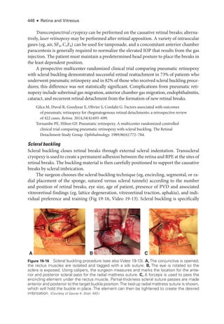 448 ● Retina and Vitreous
Transconjunctival cryopexy can be performed on the causative ret­
i­
nal breaks; alterna-
tively, ­laser retinopexy may be performed ­
after ret­
i­
nal apposition. A variety of intraocular
gases (eg, air, SF6, C3F8) can be used for tamponade, and a concomitant anterior chamber
paracentesis is generally required to normalize the elevated IOP that results from the gas
injection. The patient must maintain a predetermined head posture to place the breaks in
the least dependent position.
A prospective multicenter randomized clinical trial comparing pneumatic retinopexy
with scleral buckling demonstrated successful ret­
i­
nal reattachment in 73% of patients who
underwent pneumatic retinopexy and in 82% of ­
those who received scleral buckling proce-
dures; this difference was not statistically significant. Complications from pneumatic reti-
nopexy include subret­
i­
nal gas migration, anterior chamber gas migration, endophthalmitis,
cataract, and recurrent ret­
i­
nal detachment from the formation of new ret­
i­
nal breaks.
Gilca M, Duval R, Goodyear E, Olivier S, Cordahi G. ­
Factors associated with outcomes
of pneumatic retinopexy for rhegmatogenous ret­
i­
nal detachments: a retrospective review
of 422 cases. Ret­i­na. 2014;34(4):693–699.
Tornambe PE, Hilton GF. Pneumatic retinopexy. A multicenter randomized controlled
clinical trial comparing pneumatic retinopexy with scleral buckling. The Ret­
i­
nal
Detachment Study Group. Ophthalmology. 1989;96(6):772–784.
Scleral buckling
Scleral buckling closes ret­
i­
nal breaks through external scleral indentation. Transscleral
cryopexy is used to create a permanent adhesion between the ret­ina and RPE at the sites of
ret­
i­
nal breaks. The buckling material is then carefully positioned to support the causative
breaks by scleral imbrication.
The surgeon chooses the scleral buckling technique (eg, encircling, segmental, or ra-
dial placement of the sponge, sutured versus scleral tunnels) according to the number
and position of ret­
i­
nal breaks, eye size, age of patient, presence of PVD and associated
vitreoret­
i­
nal findings (eg, lattice degeneration, vitreoret­
i­
nal traction, aphakia), and indi-
vidual preference and training (Fig 19-16, Video 19-13). Scleral buckling is specifically
A B C
Figure 19-16 Scleral buckling procedure (see also Video 19-13). A, The conjunctiva is opened;
the rectus muscles are isolated and tagged with a silk suture. B, The eye is rotated so the
sclera is exposed. Using calipers, the surgeon mea­
sures and marks the location for the ante-
rior and posterior scleral pass for the radial mattress suture. C, A forceps is used to pass the
encircling ele­
ment ­
under the rectus muscle. Partial-­
thickness scleral suture passes are made
anterior and posterior to the target buckle position.The tied-up radial mattress suture is shown,
which ­
will hold the buckle in place. The ele­
ment can then be tightened to create the desired
imbrication. (Courtesy of Gaurav K. Shah, MD.)
 