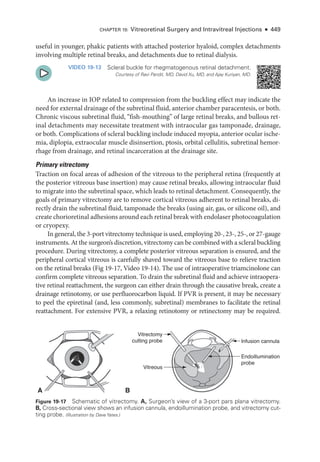 Chapter 19: Vitreoret­
i­
nal Surgery and Intravitreal Injections ● 449
useful in younger, phakic patients with attached posterior hyaloid, complex detachments
involving multiple ret­
i­
nal breaks, and detachments due to ret­
i­
nal dialysis.
VIDEO 19-13 Scleral buckle for rhegmatogenous ret­
i­
nal detachment.
Courtesy of Ravi Pandit, MD, David Xu, MD, and Ajay Kuriyan, MD.
An increase in IOP related to compression from the buckling effect may indicate the
need for external drainage of the subret­i­nal fluid, anterior chamber paracentesis, or both.
Chronic viscous subret­
i­
nal fluid, “fish-­
mouthing” of large ret­
i­
nal breaks, and bullous ret­
i­
nal detachments may necessitate treatment with intraocular gas tamponade, drainage,
or both. Complications of scleral buckling include induced myopia, anterior ocular ische­
mia, diplopia, extraocular muscle disinsertion, ptosis, orbital cellulitis, subret­
i­
nal hemor-
rhage from drainage, and ret­
i­
nal incarceration at the drainage site.
Primary vitrectomy
Traction on focal areas of adhesion of the vitreous to the peripheral ret­
ina (frequently at
the posterior vitreous base insertion) may cause ret­
i­
nal breaks, allowing intraocular fluid
to migrate into the subret­
i­
nal space, which leads to ret­
i­
nal detachment. Consequently, the
goals of primary vitrectomy are to remove cortical vitreous adherent to ret­
i­
nal breaks, di-
rectly drain the subret­
i­
nal fluid, tamponade the breaks (using air, gas, or silicone oil), and
create chorioret­i­nal adhesions around each ret­i­nal break with endolaser photocoagulation
or cryopexy.
In general, the 3-­port vitrectomy technique is used, employing 20-­, 23-­, 25-­, or 27-­gauge
instruments. At the surgeon’s discretion, vitrectomy can be combined with a scleral buckling
procedure. During vitrectomy, a complete posterior vitreous separation is ensured, and the
peripheral cortical vitreous is carefully shaved ­
toward the vitreous base to relieve traction
on the ret­
i­
nal breaks (Fig 19-17, Video 19-14). The use of intraoperative triamcinolone can
confirm complete vitreous separation. To drain the subret­
i­
nal fluid and achieve intraopera-
tive ret­
i­
nal reattachment, the surgeon can ­
either drain through the causative break, create a
drainage retinotomy, or use perfluorocarbon liquid. If PVR is pre­
sent, it may be necessary
to peel the epiret­
i­
nal (and, less commonly, subret­
i­
nal) membranes to facilitate the ret­
i­
nal
reattachment. For extensive PVR, a relaxing retinotomy or retinectomy may be required.
A B
Infusion cannula
Vitrectomy
cutting probe
Vitreous
Endoillumination
probe
Figure 19-17 Schematic of vitrectomy. A, Surgeon’s view of a 3-­
port pars plana vitrectomy.
B, Cross-­
sectional view shows an infusion cannula, endoillumination probe, and vitrectomy cut-
ting probe. (Illustration by Dave Yates.)
 