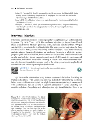 452 ● Retina and Vitreous
Banker AS, Freeman WR, Kim JW, Munguia D, Azen SP; Vitrectomy for Macular Hole Study
Group. Vision-­
threatening complications of surgery for full-­
thickness macular holes.
Ophthalmology. 1997;104(9):1442–1453.
Chang S. LXII Edward Jackson lecture: open ­
angle glaucoma ­
after vitrectomy. Am J Ophthalmol.
2006;141(6):1033–1043.
Thompson JT. The role of patient age and intraocular gases in cataract progression following
vitrectomy for macular holes and epiret­
i­
nal membranes. Trans Am Ophthalmol Soc.
2003;101:485–498.
Intravitreal Injections
Intravitreal injection is the most common procedure in ophthalmology and in medicine
in general (Fig 19-18, Video 19-15). The number of injections performed in the United
States, estimated from Medicare procedure codes, increased from fewer than 3000 per
year in 1999 to an estimated 6.5 million in 2016. The most common indications for ­
these
injections include AMD, diabetic retinopathy, and macular edema associated with venous
occlusive disease. Intravitreal injections are used most frequently to administer antian-
giogenic agents such as aflibercept, bevacizumab, and ranibizumab. Intravitreal injections
are also used to deliver ste­
roid preparations and sustained-­
delivery devices, antimicrobial
medi­
cations, and vari­
ous medi­
cations currently in clinical ­
trials. The number of intravit-
real injections continues to increase as a result of the aging population, the availability of
new medi­
cations, and an expanding list of indications.
VIDEO 19-15 Intravitreal injection of a pharmacologic agent.
Courtesy of Stephen J. Kim, MD.
Injections can be accomplished safely 3–4 mm posterior to the limbus, depending on
the lens status (­Table 19-5). Commonly employed methods for administering anesthesia
before intravitreal injections include use of pledgets or cotton-­
tipped applicators soaked
with anesthetic and held on the site of injection, application of topical (including vis-
cous) formulations of anesthetic, and subconjunctival injection of lidocaine. ­
There is no
Figure 19-18 Intravitreal injection. The ocular
surface was anesthetized with subconjunctival
injection of lidocaine, 2%, in the inferotempo-
ral quadrant. An eyelid speculum was inserted,
and povidone-­
iodine, 5%, applied to the ocu-
lar surface. ­
After 2 minutes, povidone-­
iodine
was reapplied over the injection site and—­
after proper hand placement and no talking by
the patient or the clinician—­
the injection was
made approximately 4 mm from the limbus.
(Courtesy of Stephen J. Kim, MD.)
 