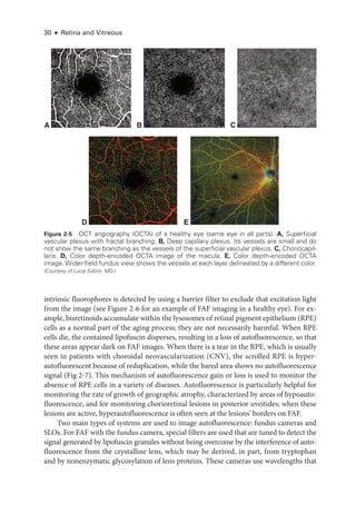 30 ● Retina and Vitreous
intrinsic fluorophores is detected by using a barrier filter to exclude that excitation light
from the image (see Figure 2-6 for an example of FAF imaging in a healthy eye). For ex-
ample, bisretinoids accumulate within the lysosomes of ret­
i­
nal pigment epithelium (RPE)
cells as a normal part of the aging pro­
cess; they are not necessarily harmful. When RPE
cells die, the contained lipofuscin disperses, resulting in a loss of autofluorescence, so that
­
these areas appear dark on FAF images. When ­
there is a tear in the RPE, which is ­
usually
seen in patients with choroidal neovascularization (CNV), the scrolled RPE is hyper­
autofluorescent ­
because of reduplication, while the bared area shows no autofluorescence
signal (Fig 2-7). This mechanism of autofluorescence gain or loss is used to monitor the
absence of RPE cells in a variety of diseases. Autofluorescence is particularly helpful for
monitoring the rate of growth of geographic atrophy, characterized by areas of hypoauto-
fluorescence, and for monitoring chorioret­
i­
nal lesions in posterior uveitides; when ­
these
lesions are active, hyperautofluorescence is often seen at the lesions’ borders on FAF.
Two main types of systems are used to image autofluorescence: fundus cameras and
SLOs. For FAF with the fundus camera, special filters are used that are tuned to detect the
signal generated by lipofuscin granules without being overcome by the interference of auto-
fluorescence from the crystalline lens, which may be derived, in part, from tryptophan
and by nonenzymatic glycosylation of lens proteins. ­
These cameras use wavelengths that
D E
A B C
Figure 2-5 OCT angiography (OCTA) of a healthy eye (same eye in all parts). A, Superficial
­
vascular plexus with fractal branching. B, Deep capillary plexus. Its vessels are small and do
not show the same branching as the vessels of the superficial vascular plexus. C, Choriocapil­
laris. D, Color depth-­
encoded OCTA image of the macula. E, Color depth-encoded OCTA
image. Wider-­
field fundus view shows the vessels at each layer delineated by a dif­
fer­
ent color.
(Courtesy of Lucia Sobrin, MD.)
 