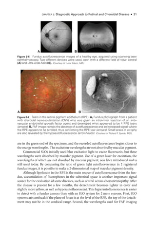 Chapter 2: Diagnostic Approach to Ret­
i­
nal and Choroidal Disease ● 31
are in the green end of the spectrum, and the recorded autofluorescence begins closer to
the orange wavelengths. The excitation wavelengths are not absorbed by macular pigment.
Commercial SLOs initially used blue excitation light to excite fluorescein, but ­
these
wavelengths ­
were absorbed by macular pigment. Use of a green ­
laser for excitation, the
wavelengths of which are not absorbed by macular pigment, was ­
later introduced and is
still used ­
today. By comparing the ratio of green light autofluorescence in 2 registered
fundus images, it is pos­
si­
ble to make a 2-­
dimensional map of macular pigment density.
Although lipofuscin in the RPE is the main source of autofluorescence from the fun-
dus, accumulation of fluorophores in the subret­
i­
nal space is another impor­
tant signal
source for the evaluation of some diseases, such as central serous chorioretinopathy. ­
After
the disease is pre­
sent for a few months, the detachment becomes lighter in color and
slightly more yellow, as well as hyperautofluorescent. This hyperautofluorescence is easier
to detect with a fundus camera than with an SLO system for 2 main reasons. First, SLO
systems are confocal; if the plane of focus is at the level of the RPE, the top of the detach-
ment may not be in the confocal range. Second, the wavelengths used for FAF imaging
B
A
A B
Figure 2-7 Tears in the ret­
i­
nal pigment epithelium (RPE). A, Fundus photo­
graph from a patient
with choroidal neovascularization (CNV) who was given an intravitreal injection of an anti–­
vascular endothelial growth ­
factor agent and developed what appeared to be 4 RPE tears
(arrows). B, FAF image reveals the absence of autofluorescence and an increased signal where
the RPE appears to be scrolled, thus confirming the RPE tear (arrows). Small areas of atrophy
are also revealed by the hypoautofluorescence (arrowheads). (Courtesy of Richard F
. Spaide, MD.)
Figure 2-6 Fundus autofluorescence images of a healthy eye, acquired using scanning ­
laser
ophthalmoscopy. Two dif­
fer­
ent devices ­
were used, each with a dif­
fer­
ent field of view: central
(A) and ultra-­wide-­field (B). (Courtesy of Lucia Sobrin, MD.)
 