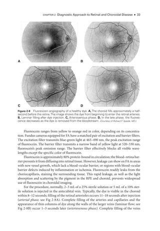 Chapter 2: Diagnostic Approach to Ret­
i­
nal and Choroidal Disease ● 33
Fluorescein ranges from yellow to orange-­
red in color, depending on its concentra-
tion. Fundus cameras equipped for FA have a matched pair of excitation and barrier filters.
The excitation filter transmits blue-­
green light at 465–490 nm, the peak excitation range
of fluorescein. The barrier filter transmits a narrow band of yellow light at 520–530 nm,
fluorescein’s peak emission range. The barrier filter effectively blocks all vis­
i­
ble wave-
lengths except the specific color of fluorescein.
Fluorescein is approximately 80% protein-­bound in circulation; the blood–­retina bar-
rier prevents it from diffusing into ret­i­nal tissue. However, leakage can show on FA in areas
with new vessel growth, which lack a blood–­
ocular barrier, or regions with blood–­
ocular
barrier defects induced by inflammation or ischemia. Fluorescein readily leaks from the
choriocapillaris, staining the surrounding tissue. This rapid leakage, as well as the light
absorption and scattering by the pigment in the RPE and choroid, prevents widespread
use of fluorescein in choroidal imaging.
For the procedure, normally, 2–3 mL of a 25% sterile solution or 5 mL of a 10% ster-
ile solution is injected in the antecubital vein. Typically, the dye is vis­
i­
ble in the choroid
within 8–12 seconds; filling of the ret­i­nal arterioles occurs 11–18 seconds ­after injection
(arterial phase; see Fig 2-8A). Complete filling of the arteries and capillaries and the
appearance of thin columns of dye along the walls of the larger veins (laminar flow; see
Fig 2-8B) occur 1–3 seconds ­
later (arteriovenous phase). Complete filling of the veins
A B
D
C
Figure 2-8 Fluorescein angiography of a healthy eye. A, The choroid fills approximately a half-­
second before the ret­
ina.The image shows the dye front beginning to enter the ret­
i­
nal arteries.
B, Laminar filling ­
after dye injection. C, Arteriovenous phase. D, In the late phase, the fluores­
cence decreases as the dye is removed from the bloodstream. (Courtesy of Richard F
. Spaide, MD.)
 