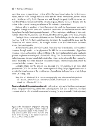 36 ● Retina and Vitreous
subret­
i­
nal space or neurosensory ret­
ina. When the inner blood–­
retina barrier is compro-
mised, the dye leaks through vascular walls into the ret­
i­
nal parenchyma, fibrotic tissue,
and cystoid spaces (Fig 2-10). Dye can also leak through the posterior blood–­
retina bar-
rier (the RPE) and accumulate in the subret­
i­
nal space, fibrotic tissue, or directly into the
ret­
ina, if the external limiting membrane of the ret­
ina is compromised.
Staining refers to a pattern of hyperfluorescence in which the fluorescence increases in
brightness through transit views and persists in late frames, but the borders remain intact
throughout the study. Staining results from entry of fluorescein into a solid tissue or into mate-
rial that retains the dye, such as a scar, drusen, blood vessel walls, optic nerve tissue, or sclera.
Pooling is the accumulation of fluorescein in a fluid-­
filled space in the ret­
ina or cho-
roid (see Fig 2-9D). As fluorescein leaks into the space, the margins of the space trap the
fluorescein and appear distinct, for example, as seen in an RPE detachment in central
serous chorioretinopathy.
A transmission defect, or win­dow defect, refers to a view of the normal choroidal fluo-
rescence through a defect in the pigment of the RPE. In a transmission defect, hyperfluo-
rescence occurs early, corresponding to filling of the choroidal circulation, and reaches its
greatest brightness with the peak of choroidal filling. This fluorescence does not increase
in brightness or size and usually fades in the late phases as the choroidal fluorescence be-
comes diluted by blood that does not contain fluorescein. The fluorescein remains in the
choroid and does not enter the ret­
ina.
Multiple defects may be pre­
sent in a diseased eye. For example, in an older adult
patient with CNV, the choroid often shows segmental filling delays; hyperfluorescence is
seen in the fovea ­
because of the proliferation of vessels that leak; and ­
there is late leakage
from CNV (Fig 2-11).
Haug S, Fu AD, Johnson RN, et al. Fluorescein angiography: basic princi­
ples and interpretation.
In: Schachat AP, Wilkinson CP, Hinton DR, Sadda SR, Wiedemann P, eds. Ryan’s Ret­i­na.
6th ed. Vol 1. Elsevier; 2017:1–45.
Adverse effects of fluorescein angiography ​
All patients injected with fluorescein experi-
ence a temporary yellowing of the skin and conjunctiva that lasts 6–12 hours. The most
common adverse effects include nausea and vomiting (in approximately 5% of injections)
Figure 2-10 Fluorescein angiogram showing
an eye with postsurgical cystoid macular
edema. Fluorescein pools in the petalloid cys­
toid spaces within the central macula, and
­
there is late staining of the optic nerve head.
(Courtesy of Richard F
. Spaide, MD.)
 