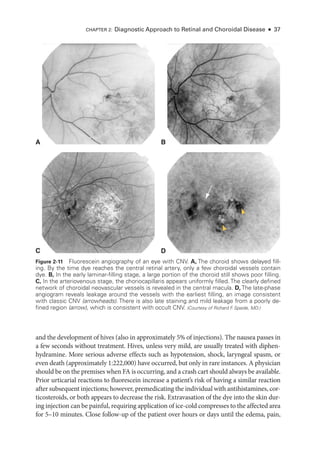 Chapter 2: Diagnostic Approach to Ret­
i­
nal and Choroidal Disease ● 37
and the development of hives (also in approximately 5% of injections). The nausea passes in
a few seconds without treatment. Hives, ­
unless very mild, are usually treated with diphen-
hydramine. More serious adverse effects such as hypotension, shock, laryngeal spasm, or
even death (approximately 1:222,000) have occurred, but only in rare instances. A physician
should be on the premises when FA is occurring, and a crash cart should always be available.
Prior urticarial reactions to fluorescein increase a patient’s risk of having a similar reaction
­after subsequent injections; however, premedicating the individual with antihistamines, cor-
ticosteroids, or both appears to decrease the risk. Extravasation of the dye into the skin dur-
ing injection can be painful, requiring application of ice-­cold compresses to the affected area
for 5–10 minutes. Close follow-up of the patient over hours or days ­
until the edema, pain,
A B
D
C
Figure 2-11 Fluorescein angiography of an eye with CNV. A, The choroid shows delayed fill­
ing. By the time dye reaches the central ret­
i­
nal artery, only a few choroidal vessels contain
dye. B, In the early laminar-­
filling stage, a large portion of the choroid still shows poor filling.
C, In the arteriovenous stage, the choriocapillaris appears uniformly filled. The clearly defined
network of choroidal neovascular vessels is revealed in the central macula. D, The late-­phase
angiogram reveals leakage around the vessels with the earliest filling, an image consistent
with classic CNV (arrowheads). ­
There is also late staining and mild leakage from a poorly de­
fined region (arrow), which is consistent with occult CNV. (Courtesy of Richard F
. Spaide, MD.)
 