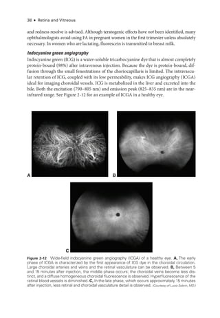 38 ● Retina and Vitreous
and redness resolve is advised. Although teratogenic effects have not been identified, many
ophthalmologists avoid using FA in pregnant ­
women in the first trimester ­
unless absolutely
necessary. In ­
women who are lactating, fluorescein is transmitted to breast milk.
Indocyanine green angiography
Indocyanine green (ICG) is a water-­
soluble tricarbocyanine dye that is almost completely
protein-­
bound (98%) ­
after intravenous injection. ­
Because the dye is protein-­
bound, dif-
fusion through the small fenestrations of the choriocapillaris is ­
limited. The intravascu-
lar retention of ICG, coupled with its low permeability, makes ICG angiography (ICGA)
ideal for imaging choroidal vessels. ICG is metabolized in the liver and excreted into the
bile. Both the excitation (790–805 nm) and emission peak (825–835 nm) are in the near-­
infrared range. See Figure 2-12 for an example of ICGA in a healthy eye.
A
C
B
Figure 2-12 Wide-­
field indocyanine green angiography (ICGA) of a healthy eye. A, The early
phase of ICGA is characterized by the first appearance of ICG dye in the choroidal circulation.
Large choroidal arteries and veins and the ret­
i­
nal vasculature can be observed. B, Between 5
and 15 minutes ­
after injection, the ­
middle phase occurs; the choroidal veins become less dis­
tinct, and a diffuse homogeneous choroidal fluorescence is observed. Hyperfluorescence of the
ret­
i­
nal blood vessels is diminished. C, In the late phase, which occurs approximately 15 minutes
­
after injection, less ret­
i­
nal and choroidal vasculature detail is observed. (Courtesy of Lucia Sobrin, MD.)
 