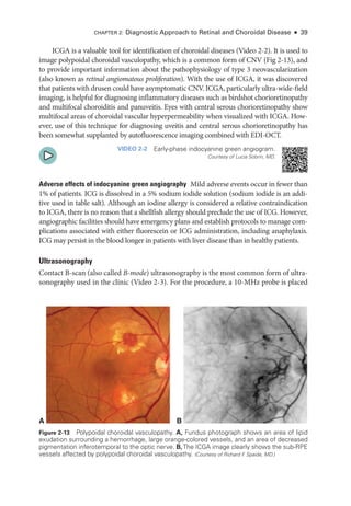 Chapter 2: Diagnostic Approach to Ret­
i­
nal and Choroidal Disease ● 39
ICGA is a valuable tool for identification of choroidal diseases (Video 2-2). It is used to
image polypoidal choroidal vasculopathy, which is a common form of CNV (Fig 2-13), and
to provide impor­
tant information about the pathophysiology of type 3 neovascularization
(also known as ret­i­nal angiomatous proliferation). With the use of ICGA, it was discovered
that patients with drusen could have asymptomatic CNV. ICGA, particularly ultra-­wide-­
field
imaging, is helpful for diagnosing inflammatory diseases such as birdshot chorioretinopathy
and multifocal choroiditis and panuveitis. Eyes with central serous chorioretinopathy show
multifocal areas of choroidal vascular hyperpermeability when visualized with ICGA. How-
ever, use of this technique for diagnosing uveitis and central serous chorioretinopathy has
been somewhat supplanted by autofluorescence imaging combined with EDI-OCT.
VIDEO 2-2 Early-­
phase indocyanine green angiogram.
Courtesy of Lucia Sobrin, MD.
Adverse effects of indocyanine green angiography ​
Mild adverse events occur in fewer than
1% of patients. ICG is dissolved in a 5% sodium iodide solution (sodium iodide is an addi-
tive used in ­
table salt). Although an iodine allergy is considered a relative contraindication
to ICGA, ­
there is no reason that a shellfish allergy should preclude the use of ICG. However,
angiographic facilities should have emergency plans and establish protocols to manage com-
plications associated with ­
either fluorescein or ICG administration, including anaphylaxis.
ICG may persist in the blood longer in patients with liver disease than in healthy patients.
Ultrasonography
Contact B-­
scan (also called B-­mode) ultrasonography is the most common form of ultra-
sonography used in the clinic (Video 2-3). For the procedure, a 10-­
MHz probe is placed
A B
Figure 2-13 Polypoidal choroidal vasculopathy. A, Fundus photo­
graph shows an area of lipid
exudation surrounding a hemorrhage, large orange-­
colored vessels, and an area of decreased
pigmentation inferotemporal to the optic nerve. B,The ICGA image clearly shows the sub-­
RPE
vessels affected by polypoidal choroidal vasculopathy. (Courtesy of Richard F
. Spaide, MD.)
 