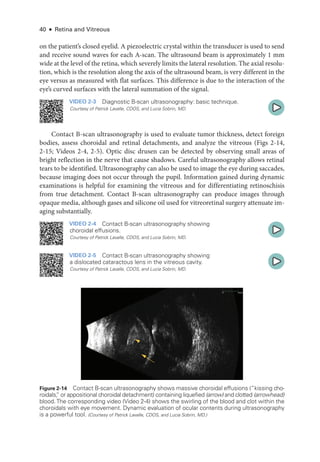 40 ● Retina and Vitreous
on the patient’s closed eyelid. A piezoelectric crystal within the transducer is used to send
and receive sound waves for each A-­
scan. The ultrasound beam is approximately 1 mm
wide at the level of the ret­ina, which severely limits the lateral resolution. The axial resolu-
tion, which is the resolution along the axis of the ultrasound beam, is very dif­
fer­
ent in the
eye versus as mea­
sured with flat surfaces. This difference is due to the interaction of the
eye’s curved surfaces with the lateral summation of the signal.
VIDEO 2-3 Diagnostic B-­
scan ultrasonography: basic technique.
Courtesy of Patrick Lavalle, CDOS, and Lucia Sobrin, MD.
Contact B-­
scan ultrasonography is used to evaluate tumor thickness, detect foreign
bodies, assess choroidal and ret­
i­
nal detachments, and analyze the vitreous (Figs 2-14,
2-15; Videos 2-4, 2-5). Optic disc drusen can be detected by observing small areas of
bright reflection in the nerve that cause shadows. Careful ultrasonography allows ret­
i­
nal
tears to be identified. Ultrasonography can also be used to image the eye during saccades,
­
because imaging does not occur through the pupil. Information gained during dynamic
examinations is helpful for examining the vitreous and for differentiating retinoschisis
from true detachment. Contact B-­
scan ultrasonography can produce images through
opaque media, although gases and silicone oil used for vitreoret­
i­
nal surgery attenuate im-
aging substantially.
VIDEO 2-4 Contact B-­
scan ultrasonography showing
choroidal effusions.
Courtesy of Patrick Lavalle, CDOS, and Lucia Sobrin, MD.
VIDEO 2-5 Contact B-­
scan ultrasonography showing
a dislocated cataractous lens in the vitreous cavity.
Courtesy of Patrick Lavalle, CDOS, and Lucia Sobrin, MD.
Figure 2-14 Contact B-­
scan ultrasonography shows massive choroidal effusions (“kissing cho­
roidals,
” or appositional choroidal detachment) containing liquefied (arrow) and clotted (arrowhead)
blood.The corresponding video (Video 2-4) shows the swirling of the blood and clot within the
choroidals with eye movement. Dynamic evaluation of ocular contents during ultrasonography
is a power­
ful tool. (Courtesy of Patrick Lavalle, CDOS, and Lucia Sobrin, MD.)
 