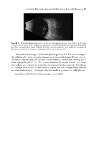 Chapter 2: Diagnostic Approach to Ret­
i­
nal and Choroidal Disease ● 41
Ultrasound biomicroscopy (UBM) uses higher frequencies than B-­
scan ultrasonogra-
phy and thus offers higher-­
resolution images but at the cost of decreased tissue penetra-
tion depth. The probe, typically 50 MHz, is contained inside a soft, water-­
filled bag that is
placed against the patient’s eye. UBM is used to evaluate the anterior chamber and ciliary
body and can also be employed to visualize the vitreous insertion anteriorly. Typical uses
in a ret­
ina practice include the evaluation of tumors, iris cysts, foreign bodies, anterior
suprachoroidal effusions, cyclodialysis clefts, intraocular lens placement, and hyphemas.
Singh AD, Lorek BH. Ophthalmic Ultrasonography. Saunders; 2012.
Figure 2-15 Dislocated cataractous lens in the vitreous cavity. B-­
scan view shows a strongly
reflective ovoid lesion with moderately reflective internal signals consistent with a dislocated
lens. The corresponding video (Video 2-5) shows the vitreous and lens and their interactions
during eye movement. (Courtesy of Patrick Lavalle, CDOS, and Lucia Sobrin, MD.)
 