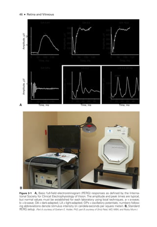 46 ● Retina and Vitreous
Amplitude,
μV
500
400
300
200
100
0
0 50 100
Time, ms
150
Amplitude,
μV
200
100
0
0 50 100
Time, ms
150
b-
b-
a-
DA 0.01
Amplitude,
μV
100
0
0 50 100
Time, ms
150
DA OPs
DA 3.0
Amplitude,
μV
500
400
300
200
100
0
0 50 100
Time, ms
150
b-
a-
DA 10.0
Amplitude,
μV
100
0
0 20 40
Time, ms
60 80
b-
a-
LA 3.0
Amplitude,
μV
100
0
0 20 40
Time, ms
60 80
peak
LA 3.0 30 Hz
Amplitude,
μV
500
400
300
200
100
0
0 50 100
Time, ms
150
b-
a-
DA 3.0
Amplitude,
μV
500
400
300
200
100
0
0 50 100
Time, ms
150
b-
a-
DA 10.0
Amplitude,
μV
100
0
0 20 40
Time, ms
60 80
b-
a-
LA 3.0
Amplitude,
μV
100
0
0 20 40
Time, ms
60 80
peak
LA 3.0 30 Hz
Amplitude,
μV
500
400
300
200
100
0
0 50 100
Time, ms
150
Amplitude,
μV
200
100
0
0 50 100
Time, ms
150
b-
b-
a-
DA 0.01
Amplitude,
μV
100
0
0 50 100
Time, ms
150
DA OPs
DA 3.0
Amplitude,
μV
100
0
0 20 40
Time, ms
60 80
peak
LA 3.0 30 Hz
A
B
Figure 3-1 A, Basic full-­
field electroretinogram (ffERG) responses as defined by the Interna-
tional Society for Clinical Electrophysiology of Vision. The amplitude and peak times are typical,
but normal values must be established for each laboratory using local techniques. a-­ =a-­
wave;
b-­ =b-­wave; DA=dark-­adapted; LA=light-­adapted; OPs=oscillatory potentials; numbers follow-
ing abbreviations denote stimulus intensity (in candela-­
seconds per square meter). B, Standard
ffERG setup. (Part A courtesy of Graham E. Holder, PhD; part B courtesy of Shriji Patel, MD, MBA, and Rocky Munn.)
 