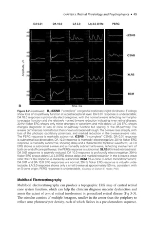 Chapter 3: Ret­
i­
nal Physiology and Psychophysics ● 49
Multifocal Electroretinography
Multifocal electroretinography can produce a topographic ERG map of central ret­
i­
nal
cone system function, which can help the clinician diagnose macular dysfunction and
assess the extent of central ret­
i­
nal involvement in generalized ret­
i­
nal disease (Fig 3 -3).
The stimulus consists of multiple hexagons, smaller in the center than the periphery to
reflect cone photoreceptor density, each of which flashes in a pseudorandom sequence.
Time, ms
Amplitude,
μV
cCSNB
iCSNB
XLRS
BCM
0
0
0 0
0
0
0 0
0 0
0 100
–4
0 100
4
0
2
–2
–4
0 100
4
0
2
–2
–4
0 100
4
0
2
–2
–4
0 100
4
0
2
–2
–4
0 50
0
0 50
150
100
50
0
0 50
150
100
50
0
0 50
150
100
50
0
0 50
150
100
50
0
0 50
0
0 50
150
100
50
0
0 50
150
100
50
0
0 50
150
100
50
0
0 50
150
100
50
0
0
100
400
200
0
100
400
200
0
100
400
200
0
100
400
200
0
100
0
100
400
200
0
100
400
200
0
100
400
200
0
100
400
200
0
100
Time, ms
cCSNB
iCSNB
XLRS
BCM
0
0
0
0
0
0 100
–4
0 100
4
0
2
–2
–4
0 100
4
0
2
–2
–4
0 100
4
0
2
–2
–4
0 100
4
0
2
–2
–4
0 50
0
0 50
150
100
50
0
0 50
150
100
50
0
0 50
150
100
50
0
0 50
150
100
50
0
0 50
0
0 50
150
100
50
0
0 50
150
100
50
0
0 50
150
100
50
0
0 50
150
100
50
0
0
100
400
200
0
100
400
200
0
100
400
200
0
100
400
200
0
100
100
100
100
100
100
Amplitude,
μV
0
0
0 0
0
0
0 0
0 0
0 100
–4
0 100
4
0
2
–2
–4
0 100
4
0
2
–2
–4
0 100
4
0
2
–2
–4
0 100
4
0
2
–2
–4
0 50
0
0 50
150
100
50
0
0 50
150
100
50
0
0 50
150
100
50
0
0 50
150
100
50
0
0 50
0
0 50
150
100
50
0
0 50
150
100
50
0
0 50
150
100
50
0
0 50
150
100
50
0
0
100
400
200
0
100
400
200
0
100
400
200
0
100
400
200
0
100
0
100
400
200
0
100
400
200
0
100
400
200
0
100
400
200
0
100
Time, ms
Amplitude,
μV
cCSNB
iCSNB
XLRS
BCM
0
0
0 0
0
0
0 0
0 0
0 100
–4
0 100
4
0
2
–2
–4
0 100
4
0
2
–2
–4
0 100
4
0
2
–2
–4
0 100
4
0
2
–2
–4
0 50
0
0 50
150
100
50
0
0 50
150
100
50
0
0 50
150
100
50
0
0 50
150
100
50
0
0 50
0
0 50
150
100
50
0
0 50
150
100
50
0
0 50
150
100
50
0
0 50
150
100
50
0
0
100
400
200
0
100
400
200
0
100
400
200
0
100
400
200
0
100
0
100
400
200
0
100
400
200
0
100
400
200
0
100
400
200
0
100
Time, ms
Rod–cone
dystrophy
(RP);
macula
spared
A
B
DA 0.01 DA 10.0 LA 3.0 30 Hz
LA 3.0 PERG
Figure 3-2 (continued) B, cCSNB (“complete” congenital stationary night blindness): Findings
show loss of on-­
pathway function at a postreceptoral level. DA 0.01 response is undetectable;
DA 10.0 response is profoundly electronegative, with the normal a-­
wave reflecting normal pho-
toreceptor function and the relatively marked b-­
wave reduction indicating inner ret­
i­
nal disease;
30-­
Hz flicker ERG shows only minor changes in waveform and mild delay; LA 3.0 ERG shows
changes diagnostic of loss of cone on-­
pathway function but sparing of the off-­
pathway. The
­
a-­
wave commences normally but then shows a broadened trough.The b-­
wave rises sharply, with
loss of the photopic oscillatory potentials, and marked reduction in the b-wave:a-wave ratio.
The PERG response is markedly subnormal. iCSNB (“incomplete” CSNB): DA 0.01 response
is subnormal but detectable; DA 10.0 response is markedly electronegative; 30-­
Hz flicker ERG
response is markedly subnormal, showing delay and a characteristic triphasic waveform; LA 3.0
ERG shows a subnormal a-­
wave and a markedly subnormal b-­
wave, reflecting involvement of
both on-­and off-­
cone pathways; the PERG response is subnormal. XLRS (X-­
linked retinoschisis):
DA 0.01 response is severely reduced; DA 10.0 response is profoundly electronegative; 30-­
Hz
flicker ERG shows delay; LA 3.0 ERG shows delay and marked reduction in the b-wave:­
a-wave
ratio; the PERG response is markedly subnormal. BCM (blue-­
cone [S-­
cone] monochromatism):
DA 0.01 and DA 10.0 ERG responses are normal; 30-­
Hz flicker ERG response is virtually unde-
tectable; LA 3.0 response shows only a small b-­
wave at approximately 50 ms, consistent with
an S-­
cone origin; PERG response is undetectable. (Courtesy of Graham E. Holder, PhD.)
 