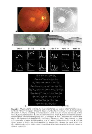 E
1 µV
50 ms
Amp.P1 [nV/deg2
]
D
DA 0.01 DA 10.0
400
200
0
0 100
400
200
0
0
100
400
200
0
200
150
100
50
0
0 100 0 50
200
150
100
50
0
0 50
4
2
0
–2
–4
0 100
4
2
0
–2
–4
0 100
4
2
0
–2
–4
0 100
4
2
0
–2
–4
0 100
200
150
100
50
0
0 50
200
150
100
50
0
0 50
400
200
0
0 100
LA 3.0 30 Hz LA 3.0 PERG 15° PERG 30°
A B 200 µm
C
DA 0.01 DA 10.0
400
200
0
200
150
100
50
0
0 100 0 50
200
150
100
50
0
0 50
4
2
0
–2
–4
0 100
4
2
0
–2
–4
0 100
4
2
0
–2
–4
0 100
4
2
0
–2
–4
0 100
200
150
100
50
0
0 50
200
150
100
50
0
0 50
400
200
0
0 100
LA 3.0 30 Hz LA 3.0 PERG 15° PERG 30°
D
DA 0.01 DA 10.0
400
200
0
0 100
400
200
0
0
100
400
200
0
200
150
100
50
0
0 100 0 50
200
150
100
50
0
0 50
4
2
0
–2
–4
0 100
4
2
0
–2
–4
0 100
200
150
100
50
0
0 50
200
150
100
50
0
0 50
400
200
0
0 100
LA 3.0 30 Hz LA 3.0 PERG 15°
Figure 3-3 Multifocal ERG (mfERG), full-­
field ERG (ffERG), and pattern ERG (PERG) from a pa-
tient with ABCA4 retinopathy (Stargardt disease; fundus flavimaculatus) show the importance
of fixation in mfERG recording and interpretation. A–­C: Macular atrophy centralized on the
fovea. A, Fundus photograph. B, Fundus autofluorescence image. C, Near-­
infrared and spectral-­
domain optical coherence tomography (SD-­
OCT) images. D, ffERG responses are normal (see
Fig 3-1 for explanation of abbreviations; x-­
axis = ms; y-­
axis = μV); PERG response to a 15° field
is undetectable; however, PERG response to a 30° field is pre­
sent but subnormal. E, mfERG
shows an area of dysfunction that is localized but apparently not around the fovea, which sim-
ply reflects the eccentric fixation often pre­
sent in a patient with a central scotoma. (Courtesy of
Graham E. Holder, PhD.)
 