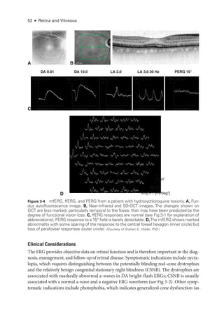 52 ● Retina and Vitreous
Clinical Considerations
The ERG provides objective data on ret­
i­
nal function and is therefore impor­
tant in the diag­
nosis, management, and follow-up of ret­
i­
nal disease. Symptomatic indications include nycta­
lopia, which requires distinguishing between the potentially blinding rod–­
cone dystrophies
and the relatively benign congenital stationary night blindness (CSNB). The dystrophies are
associated with markedly abnormal a-­
waves in DA bright-­
flash ERGs; CSNB is usually
associated with a normal a-­
wave and a negative ERG waveform (see Fig 3 -2). Other symp­
tomatic indications include photophobia, which indicates generalized cone dysfunction (as
A B
C
D
200 μm
200 μm
2 μV
50 ms
Amp.P1 [nV/deg2
]
100 μV/Div
DA 0.01 DA 10.0
50 ms/Div
+
100 μV/Div
50 ms/Div
+
100 μV/Div
50 ms/Div
+
100 μV/Div
50 ms/Div
+
100 μV/Div
50 ms/Div
+
LA 3.0 30 Hz LA 3.0 PERG 15°
100 μV/Div
DA 10.0
50 ms/Div
+
100 μV/Div
50 ms/Div
+
100 μV/Div
50 ms/Div
+
100 μV/Div
50 ms/Div
+
LA 3.0 30 Hz LA 3.0 PERG 15°
100 μV/Div
DA 0.01 DA 10.0
50 ms/Div
+
100 μV/Div
50 ms/Div
+
100 μV/Div
50 ms/Div
+
100 μV/Div
50 ms/Div
+
LA 3.0 30 Hz LA 3.0
Figure 3-4 mfERG, ffERG, and PERG from a patient with hydroxychloroquine toxicity. A, Fun-
dus autofluorescence image. B, Near-­
infrared and SD-­
OCT images. The changes shown on
OCT are less marked, particularly temporal to the fovea, than may have been predicted by the
degree of functional vision loss. C, ffERG responses are normal (see Fig 3-1 for explanation of
abbreviations); PERG response to a 15° field is barely detectable. D,The mfERG shows marked
abnormality with some sparing of the response to the central foveal hexagon (inner circle) but
loss of parafoveal responses (outer circle). (Courtesy of Graham E. Holder, PhD.)
 