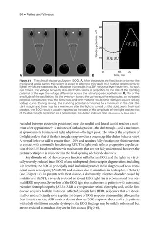54 ● Retina and Vitreous
recorded between electrodes positioned near the medial and lateral canthi reaches a mini­
mum ­
after approximately 12 minutes of dark adaptation—­
the dark trough—­
and a maximum
at approximately 8 minutes of light adaptation—­
the light peak. The ratio of the amplitude of
the light peak to that of the dark trough is expressed as a percentage (the Arden index or ratio).
A normal light rise ­
will be greater than 170% and requires fully functioning photoreceptors
in contact with a normally functioning RPE. The light peak reflects progressive depolariza­
tion of the RPE basal membrane via mechanisms that are not fully understood; however, the
protein bestrophin is implicated in the final opening of chloride channels.
Any disorder of rod photoreceptor function ­will affect an EOG, and the light rise is typi­
cally severely reduced in an EOG of any widespread photoreceptor degeneration, including
RP. However, the EOG is principally used in clinical practice in the diagnosis of acute zonal
occult outer retinopathy (AZOOR) and diseases due to mutations in bestrophin 1 (BEST1)
(see Chapter 12). In patients with Best disease, a dominantly inherited disorder caused by
mutations in BEST1, a severely reduced or absent EOG light rise is accompanied by a nor­
mal ffERG response. Severe loss of the EOG light rise is also seen in patients with autosomal
recessive bestrophinopathy (ARB). ARB is a progressive ret­
i­
nal dystrophy and, unlike Best
disease, requires biallelic mutation. Affected patients have ffERG responses that are abnor­
mal but not sufficiently so to explain the degree of EOG response abnormality. Also, unlike
Best disease carriers, ARB carriers do not show an EOG response abnormality. In patients
with adult vitelliform macular dystrophy, the EOG findings may be mildly subnormal but
are not reduced as much as they are in Best disease (Fig 3 - 6).
A B
Lights on
15°
15°
15°
15°
Time, min
Standing
potentials,
mV
40
30
20
10
10
0 20
Lights out
Figure 3-5 The clinical electro-­
oculogram (EOG). A, ­
After electrodes are fixed to an area near the
medial and lateral canthi, the patient is asked to alternate their gaze on 2 fixation targets (dimly lit
lights), which are separated by a distance that results in a 30° horizontal eye movement. As each
eye moves, the voltage between skin electrodes varies in proportion to the size of the standing
potential of the eye (the voltage differential across the ret­
i­
nal pigment epithelium). B, Plot of the
amplitude of the oscillations. As the eyes turn ­
toward the cornea-­
positive electrodes, an increased
potential is mea­
sured; thus, the slow back-­
and-­
forth motions result in the relatively square-­
looking
voltage curve. During testing, the standing potential diminishes to a minimum in the dark (the
dark trough) and then rises to a maximum ­
after the light is turned on (the light peak). In clinical
practice, the EOG result is usually reported as the ratio of the amplitude of the light peak to that
of the dark trough expressed as a percentage, the Arden index or ratio. (Illustrations by Mark Miller.)
 