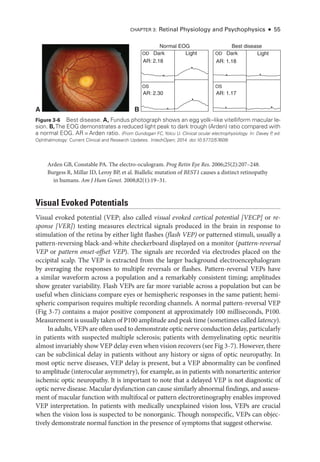 Chapter 3: Ret­
i­
nal Physiology and Psychophysics ● 55
Arden GB, Constable PA. The electro-­
oculogram. Prog Retin Eye Res. 2006;25(2):207–248.
Burgess R, Millar ID, Leroy BP, et al. Biallelic mutation of BEST1 ­
causes a distinct retinopathy
in ­humans. Am J Hum Genet. 2008;82(1):19–31.
Visual Evoked Potentials
Visual evoked potential (VEP; also called visual evoked cortical potential [VECP] or re-
sponse [VER]) testing mea­
sures electrical signals produced in the brain in response to
stimulation of the ret­
ina by ­
either light flashes (flash VEP) or patterned stimuli, usually a
pattern-­
reversing black-­
and-­
white checkerboard displayed on a monitor (pattern-­reversal
VEP or pattern onset-­
offset VEP). The signals are recorded via electrodes placed on the
occipital scalp. The VEP is extracted from the larger background electroencephalogram
by averaging the responses to multiple reversals or flashes. Pattern-­
reversal VEPs have
a similar waveform across a population and a remarkably consistent timing; amplitudes
show greater variability. Flash VEPs are far more variable across a population but can be
useful when clinicians compare eyes or hemispheric responses in the same patient; hemi­
spheric comparison requires multiple recording channels. A normal pattern-­
reversal VEP
(Fig 3 -7) contains a major positive component at approximately 100 milliseconds, P100.
Mea­sure­ment is usually taken of P100 amplitude and peak time (sometimes called latency).
In adults, VEPs are often used to demonstrate optic nerve conduction delay, particularly
in patients with suspected multiple sclerosis; patients with demyelinating optic neuritis
almost invariably show VEP delay even when vision recovers (see Fig 3 -7). However, ­there
can be subclinical delay in patients without any history or signs of optic neuropathy. In
most optic nerve diseases, VEP delay is pre­
sent, but a VEP abnormality can be confined
to amplitude (interocular asymmetry), for example, as in patients with nonarteritic anterior
ischemic optic neuropathy. It is impor­
tant to note that a delayed VEP is not diagnostic of
optic nerve disease. Macular dysfunction can cause similarly abnormal findings, and assess­
ment of macular function with multifocal or pattern electroretinography enables improved
VEP interpretation. In patients with medically unexplained vision loss, VEPs are crucial
when the vision loss is suspected to be nonorganic. Though nonspecific, VEPs can objec­
tively demonstrate normal function in the presence of symptoms that suggest other­
wise.
A B
Normal EOG Best disease
Dark
AR: 2.18 AR: 1.18
AR: 2.30
OD
OS
AR: 1.17
OS
Light Dark
OD Light
Figure 3-6 Best disease. A, Fundus photo­
graph shows an egg yolk–­
like vitelliform macular le-
sion. B,The EOG demonstrates a reduced light peak to dark trough (Arden) ratio compared with
a normal EOG. AR =Arden ratio. (From Gundogan FC, Yolcu U. Clinical ocular electrophysiology. In: Davey P
, ed.
Ophthalmology: Current Clinical and Research Updates. IntechOpen; 2014. doi:10.5772/57609)
 