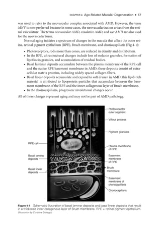 Chapter 4: Age-­
Related Macular Degeneration ● 67
was used to refer to the neovascular complex associated with AMD. However, the term
MNV is now preferred ­
because in some cases, the neovascularization arises from the ret­
i­
nal vasculature. The terms neovascular AMD, exudative AMD, and wet AMD are also used
for the neovascular form.
Normal aging initiates a spectrum of changes in the macula that affect the outer ret­
ina, ret­
i­
nal pigment epithelium (RPE), Bruch membrane, and choriocapillaris (Fig 4-1):
• Photoreceptors, rods more than cones, are reduced in density and distribution.
• In the RPE, ultrastructural changes include loss of melanin granules, formation of
lipofuscin granules, and accumulation of residual bodies.
• Basal laminar deposits accumulate between the plasma membrane of the RPE cell
and the native RPE basement membrane in AMD; ­
these deposits consist of extra-
cellular matrix proteins, including widely spaced collagen fibers.
• Basal linear deposits accumulate and expand to soft drusen in AMD; this lipid-­
rich
material is attributed to lipoprotein particles that accumulate between the base-
ment membrane of the RPE and the inner collagenous layer of Bruch membrane.
• In the choriocapillaris, progressive involutional changes occur.
All of ­
these changes represent aging and may not be part of AMD pathology.
}
RPE cell
Photoreceptor
outer segment
Villous process
Pigment granules
Plasma membrane
of RPE
Basement
membrane
of RPE
Basement
membrane of
choriocapillaris
Choriocapillaris
Bruch
membrane
Basal laminar
deposits
Basal linear
deposits
Figure 4-1 Schematic illustration of basal laminar deposits and basal linear deposits that result
in a thickened inner collagenous layer of Bruch membrane. RPE = ret­
i­
nal pigment epithelium.
(Illustration by Christine Gralapp.)
 
