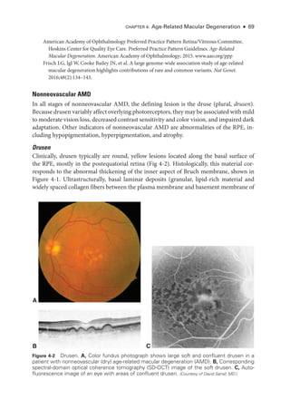 Chapter 4: Age-­
Related Macular Degeneration ● 69
American Acad­
emy of Ophthalmology Preferred Practice Pattern Ret­
i­
na/Vitreous Committee,
Hoskins Center for Quality Eye Care. Preferred Practice Pattern Guidelines. Age-­Related
Macular Degeneration. American Acad­
emy of Ophthalmology; 2015. www.aao.org/ppp
Frisch LG, Igl W, Cooke Bailey JN, et al. A large genome-­
wide association study of age-­
related
macular degeneration highlights contributions of rare and common variants. Nat Genet.
2016;48(2):134–143.
Nonneovascular AMD
In all stages of nonneovascular AMD, the defining lesion is the druse (plural, drusen).
­Because drusen variably affect overlying photoreceptors, they may be associated with mild
to moderate vision loss, decreased contrast sensitivity and color vision, and impaired dark
adaptation. Other indicators of nonneovascular AMD are abnormalities of the RPE, in-
cluding hypopigmentation, hyperpigmentation, and atrophy.
Drusen
Clinically, drusen typically are round, yellow lesions located along the basal surface of
the RPE, mostly in the postequatorial ret­
ina (Fig 4-2). Histologically, this material cor-
responds to the abnormal thickening of the inner aspect of Bruch membrane, shown in
Figure 4-1. Ultrastructurally, basal laminar deposits (granular, lipid-­
rich material and
widely spaced collagen fibers between the plasma membrane and basement membrane of
B C
A
Figure 4-2 Drusen. A, Color fundus photo­
graph shows large soft and confluent drusen in a
patient with nonneovascular (dry) age-­
related macular degeneration (AMD). B, Corresponding
spectral-­
domain optical coherence tomography (SD-­
OCT) image of the soft drusen. C, Auto-
fluorescence image of an eye with areas of confluent drusen. (Courtesy of David Sarraf, MD.)
 