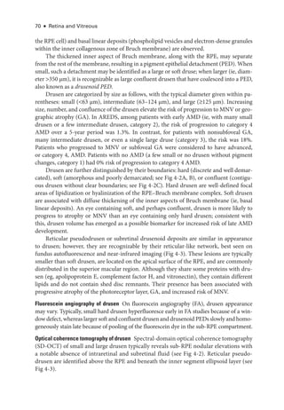 70 ● Retina and Vitreous
the RPE cell) and basal linear deposits (phospholipid vesicles and electron-­
dense granules
within the inner collagenous zone of Bruch membrane) are observed.
The thickened inner aspect of Bruch membrane, along with the RPE, may separate
from the rest of the membrane, resulting in a pigment epithelial detachment (PED). When
small, such a detachment may be identified as a large or soft druse; when larger (ie, diam-
eter >350 μm), it is recognizable as large confluent drusen that have coalesced into a PED,
also known as a drusenoid PED.
Drusen are categorized by size as follows, with the typical dia­
meter given within pa-
rentheses: small (<63 μm), intermediate (63–124 μm), and large (≤125 μm). Increasing
size, number, and confluence of the drusen elevate the risk of progression to MNV or geo-
graphic atrophy (GA). In AREDS, among patients with early AMD (ie, with many small
drusen or a few intermediate drusen, category 2), the risk of progression to category 4
AMD over a 5-­
year period was 1.3%. In contrast, for patients with nonsubfoveal GA,
many intermediate drusen, or even a single large druse (category 3), the risk was 18%.
Patients who progressed to MNV or subfoveal GA ­
were considered to have advanced,
or category 4, AMD. Patients with no AMD (a few small or no drusen without pigment
changes, category 1) had 0% risk of progression to category 4 AMD.
Drusen are further distinguished by their bound­
aries: hard (discrete and well demar-
cated), soft (amorphous and poorly demarcated; see Fig 4-2A, B), or confluent (contigu-
ous drusen without clear bound­
aries; see Fig 4-2C). Hard drusen are well-­
defined focal
areas of lipidization or hyalinization of the RPE–­
Bruch membrane complex. Soft drusen
are associated with diffuse thickening of the inner aspects of Bruch membrane (ie, basal
linear deposits). An eye containing soft, and perhaps confluent, drusen is more likely to
pro­
gress to atrophy or MNV than an eye containing only hard drusen; consistent with
this, drusen volume has emerged as a pos­
si­
ble biomarker for increased risk of late AMD
development.
Reticular pseudodrusen or subret­
i­
nal drusenoid deposits are similar in appearance
to drusen; however, they are recognizable by their reticular-­
like network, best seen on
fundus autofluorescence and near-­
infrared imaging (Fig 4-3). ­
These lesions are typically
smaller than soft drusen, are located on the apical surface of the RPE, and are commonly
distributed in the superior macular region. Although they share some proteins with dru-
sen (eg, apolipoprotein E, complement ­
factor H, and vitronectin), they contain dif­
fer­
ent
lipids and do not contain shed disc remnants. Their presence has been associated with
progressive atrophy of the photoreceptor layer, GA, and increased risk of MNV.
Fluorescein angiography of drusen ​
On fluorescein angiography (FA), drusen appearance
may vary. Typically, small hard drusen hyperfluoresce early in FA studies ­
because of a win­
dow defect, whereas larger soft and confluent drusen and drusenoid PEDs slowly and homo-
geneously stain late ­
because of pooling of the fluorescein dye in the sub-­
RPE compartment.
Optical coherence tomography of drusen ​Spectral-­domain optical coherence tomography
(SD-­
OCT) of small and large drusen typically reveals sub-­
RPE nodular elevations with
a notable absence of intraret­
i­
nal and subret­
i­
nal fluid (see Fig 4-2). Reticular pseudo-
drusen are identified above the RPE and beneath the inner segment ellipsoid layer (see
Fig 4-3).
 
