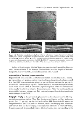 Chapter 4: Age-­
Related Macular Degeneration ● 71
Enhanced depth imaging (EDI) OCT provides more details of choroidal architecture
and a clearer definition of the choroidal-­
scleral interface, which is helpful in character-
izing AMD. In eyes with AMD, choroidal thickness is often reduced.
Abnormalities of the ret­
i­
nal pigment epithelium
In patients with nonneovascular AMD, characteristic RPE abnormalities include focal hy-
perpigmentation or hypopigmentation, intraret­i­nal pigment migration, focal atrophy, and
GA. Focal RPE hyperpigmentation appears as increased pigmentation at the level of the
outer ret­
ina. ­
These areas typically block fluorescence on FA and appear as hyperreflective
outer ret­
i­
nal foci on SD-­
OCT. Intraret­
i­
nal pigment migration within the neurosensory
ret­
ina may be visualized superficial to drusen or drusenoid PEDs. The incidence of ­
these
abnormalities increases with age, and their presence increases the risk of progression to
more advanced forms of AMD.
Geographic atrophy ​
In the eye, focal atrophy can appear clinically as areas of mottled pig-
mentation or depigmentation. When ­
these lesions are contiguous and have a dia­
meter
greater than 175 μm, they are described as GA of the RPE. In areas of GA, absence or
depigmentation of the RPE exposes the choroidal vessels. The overlying outer ret­
ina typi-
cally appears thin, and the under­
lying choriocapillaris is attenuated or atrophied. On FA,
GA appears as well-­
circumscribed win­
dow defects of varying sizes corresponding to the
B C
A
Figure 4-3 Reticular pseudodrusen. A, Near-­
infrared reflectance image shows the multi­
focal
and typical netlike arrangement of pseudodrusen. Green arrows mark locations of B (top
arrow) and C (bottom arrow). B, SD-­
OCT image demonstrates the location of typical peak-­
shaped reticular pseudodrusen above the RPE. C, SD-­
OCT image demonstrates the location of
undulating reticular pseudodrusen above the RPE. (Courtesy of Charles C. Wykoff, MD, PhD.)
 