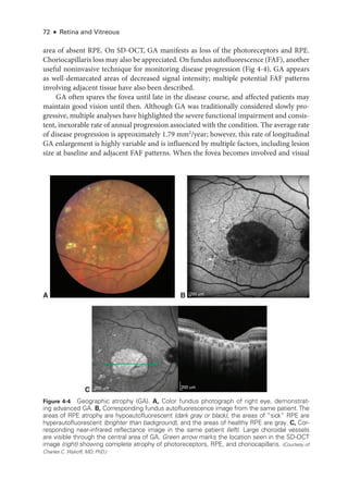 72 ● Retina and Vitreous
area of absent RPE. On SD-­
OCT, GA manifests as loss of the photoreceptors and RPE.
Choriocapillaris loss may also be appreciated. On fundus autofluorescence (FAF), another
useful noninvasive technique for monitoring disease progression (Fig 4-4), GA appears
as well-­
demarcated areas of decreased signal intensity; multiple potential FAF patterns
involving adjacent tissue have also been described.
GA often spares the fovea ­
until late in the disease course, and affected patients may
maintain good vision ­
until then. Although GA was traditionally considered slowly pro-
gressive, multiple analyses have highlighted the severe functional impairment and consis-
tent, inexorable rate of annual progression associated with the condition. The average rate
of disease progression is approximately 1.79 mm2
/year; however, this rate of longitudinal
GA enlargement is highly variable and is influenced by multiple ­
factors, including lesion
size at baseline and adjacent FAF patterns. When the fovea becomes involved and visual
A
C
B 200 μm
200 μm
200 μm
Figure 4-4 Geographic atrophy (GA). A, Color fundus photo­
graph of right eye, demonstrat-
ing advanced GA. B, Corresponding fundus autofluorescence image from the same patient.The
areas of RPE atrophy are hypoautofluorescent (dark gray or black), the areas of “sick” RPE are
hyperautofluorescent (brighter than background), and the areas of healthy RPE are gray. C, Cor-
responding near-­
infrared reflectance image in the same patient (left). Large choroidal vessels
are vis­
i­
ble through the central area of GA. Green arrow marks the location seen in the SD-­
OCT
image (right) showing complete atrophy of photoreceptors, RPE, and choriocapillaris. (Courtesy of
Charles C. Wykoff, MD, PhD.)
 