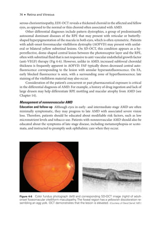 74 ● Retina and Vitreous
serous chorioretinopathy, EDI-­OCT reveals a thickened choroid in the affected and fellow
eyes, as opposed to the normal or thin choroid often associated with AMD.
Other differential diagnoses include pattern dystrophies, a group of predominantly
autosomal dominant diseases of the RPE that may pre­
sent with reticular or butterfly-­
shaped hyperpigmentation of the macula in both eyes, which is often symmetric. Patients
with adult-­
onset foveomacular vitelliform dystrophy (AOFVD) may pre­
sent with unilat-
eral or bilateral yellow subret­
i­
nal lesions. On SD-­
OCT, this condition appears as a hy-
perreflective, dome-­
shaped central lesion between the photoreceptor layer and the RPE,
often with subret­i­nal fluid that is not responsive to anti‒vascular endothelial growth ­factor
(anti-­
VEGF) therapy (Fig 4-6). However, unlike in AMD, increased subfoveal choroidal
thickness is frequently apparent in AOFVD. FAF typically shows decreased central auto­
fluorescence corresponding to the lesion with annular hyperautofluorescence. On FA,
early blocked fluorescence is seen, with a surrounding zone of hyperfluorescence; late
staining of the vitelliform material may also occur.
Consideration of the patient’s concurrent or past phar­
ma­
ceu­
ti­
cal exposure is critical
in the differential diagnosis of AMD. For example, a history of drug ingestion and lack of
large drusen may help differentiate RPE mottling and macular atrophy from AMD (see
Chapter 14).
Management of nonneovascular AMD
Education and follow-­
up ​
Although eyes in early-­and intermediate-­
stage AMD are often
minimally symptomatic, they may pro­
gress to late AMD with associated severe vision
loss. Therefore, patients should be educated about modifiable risk ­
factors, such as low
micronutrient levels and tobacco use. Patients with nonneovascular AMD should also be
educated about the symptoms of late-­
stage disease, including metamorphopsia or scoto-
mata, and instructed to promptly seek ophthalmic care when they occur.
Figure 4-6 Color fundus photo­
graph (left) and corresponding SD-­
OCT image (right) of adult-­
onset foveomacular vitelliform maculopathy.The foveal region has a yellowish discoloration re-
sembling an egg yolk. OCT demonstrates that the lesion is elevated. (Courtesy of David Sarraf, MD.)
 