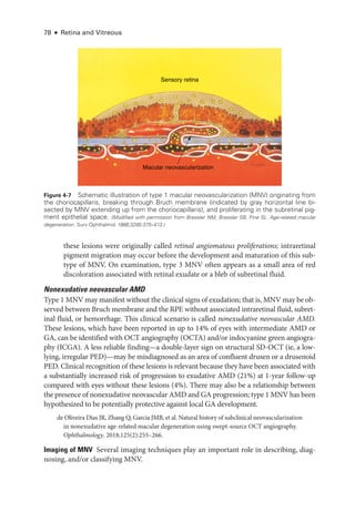 78 ● Retina and Vitreous
­
these lesions ­
were originally called ret­i­nal angiomatous proliferations; intraret­i­nal
pigment migration may occur before the development and maturation of this sub-
type of MNV. On examination, type 3 MNV often appears as a small area of red
discoloration associated with ret­
i­
nal exudate or a bleb of subret­
i­
nal fluid.
Nonexudative neovascular AMD
Type 1 MNV may manifest without the clinical signs of exudation; that is, MNV may be ob-
served between Bruch membrane and the RPE without associated intraret­
i­
nal fluid, subret­
i­
nal fluid, or hemorrhage. This clinical scenario is called nonexudative neovascular AMD.
­
These lesions, which have been reported in up to 14% of eyes with intermediate AMD or
GA, can be identified with OCT angiography (OCTA) and/or indocyanine green angiogra-
phy (ICGA). A less reliable finding—­
a double-­
layer sign on structural SD-­
OCT (ie, a low-­
lying, irregular PED)—­
may be misdiagnosed as an area of confluent drusen or a drusenoid
PED. Clinical recognition of ­
these lesions is relevant ­
because they have been associated with
a substantially increased risk of progression to exudative AMD (21%) at 1-­
year follow-up
compared with eyes without ­
these lesions (4%). ­
There may also be a relationship between
the presence of nonexudative neovascular AMD and GA progression; type 1 MNV has been
hypothesized to be potentially protective against local GA development.
de Oliveira Dias JR, Zhang Q, Garcia JMB, et al. Natu­
ral history of subclinical neovascularization
in nonexudative age-­
related macular degeneration using swept-­
source OCT angiography.
Ophthalmology. 2018;125(2):255–266.
Imaging of MNV ​
Several imaging techniques play an impor­
tant role in describing, diag-
nosing, and/or classifying MNV.
Sensory retina
Macular neovascularization
Figure 4-7 Schematic illustration of type 1 macular neovascularization (MNV) originating from
the choriocapillaris, breaking through Bruch membrane (indicated by gray horizontal line bi-
sected by MNV extending up from the choriocapillaris), and proliferating in the subret­
i­
nal pig-
ment epithelial space. (Modified with permission from Bressler NM, Bressler SB, Fine SL. Age-­
related macular
degeneration. Surv Ophthalmol.1988;32(6):375–413.)
 
