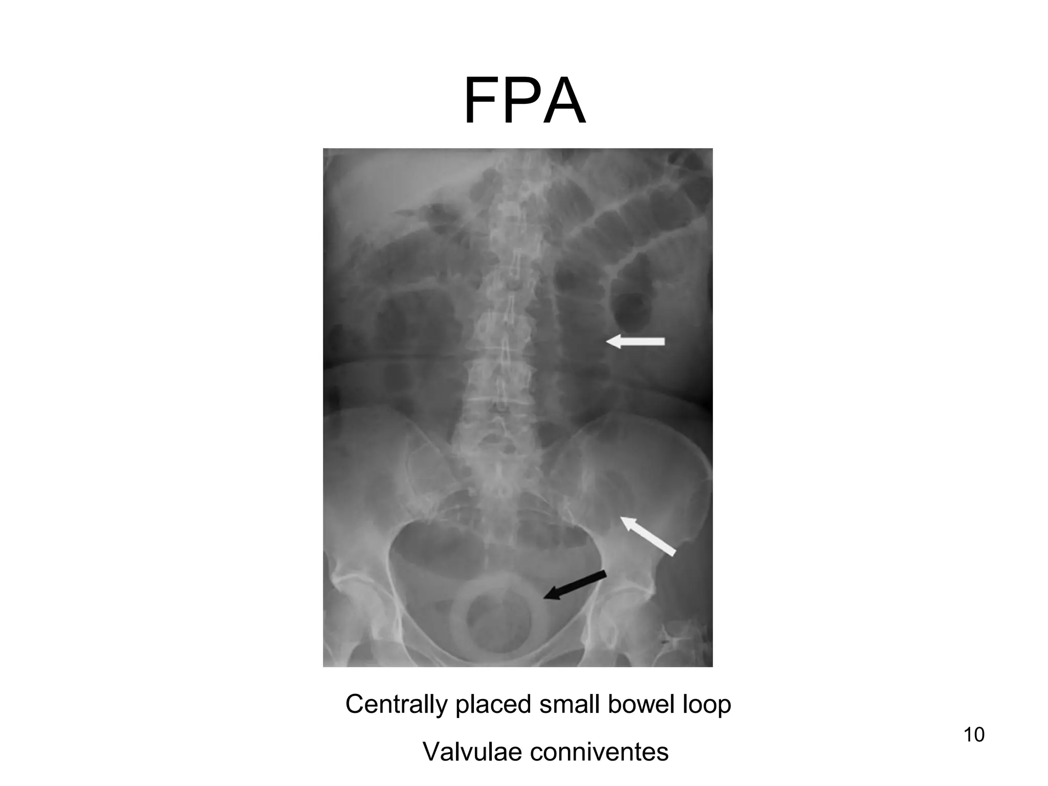 10
FPA
Centrally placed small bowel loop
Valvulae conniventes
 