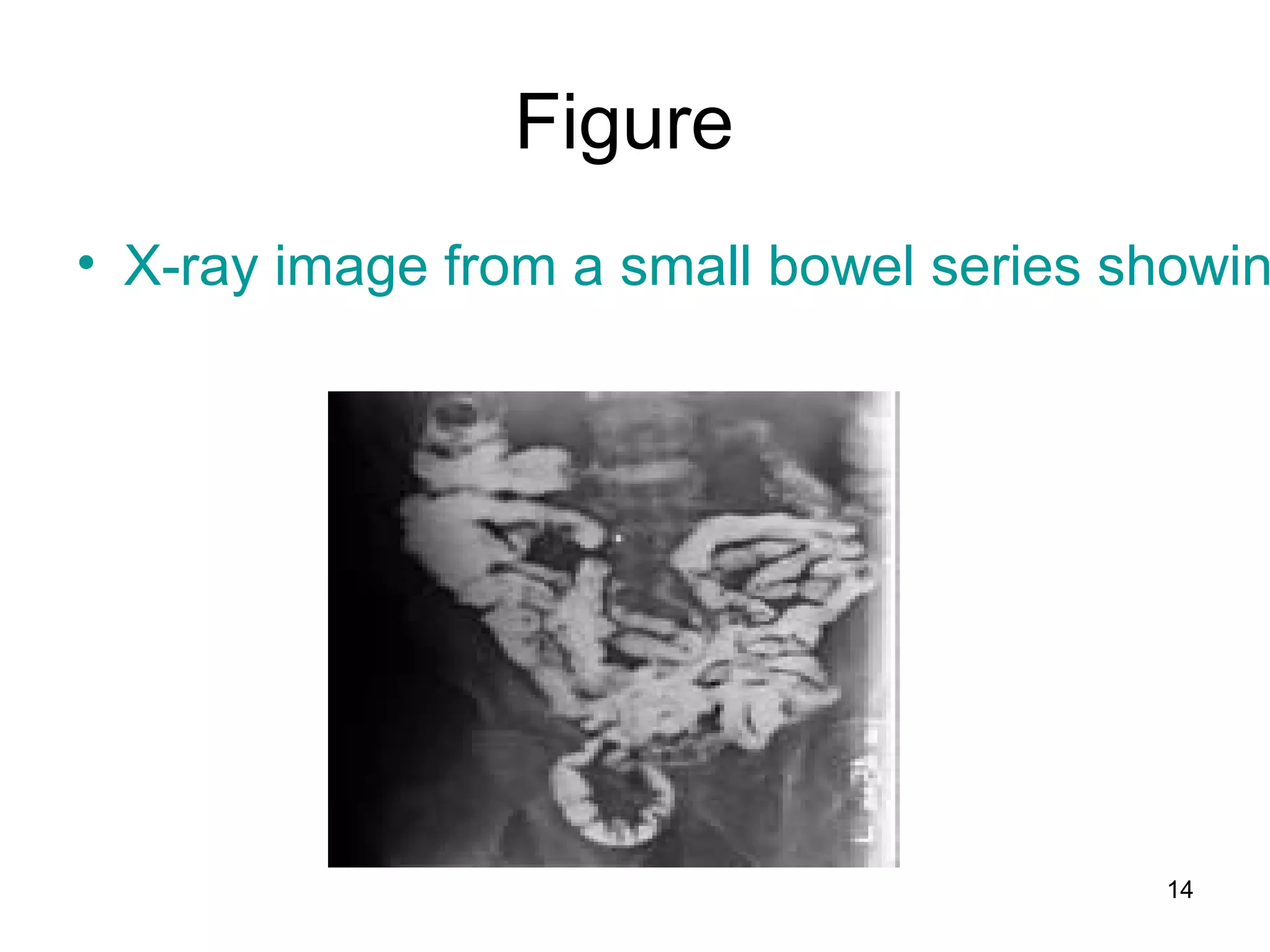 14
Figure
• X-ray image from a small bowel series showin
 