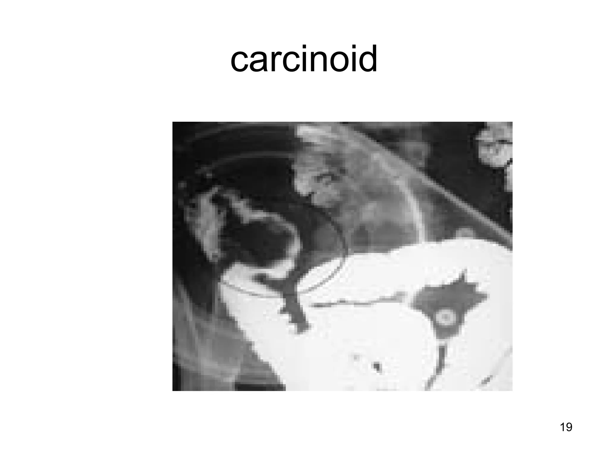 19
carcinoid
 