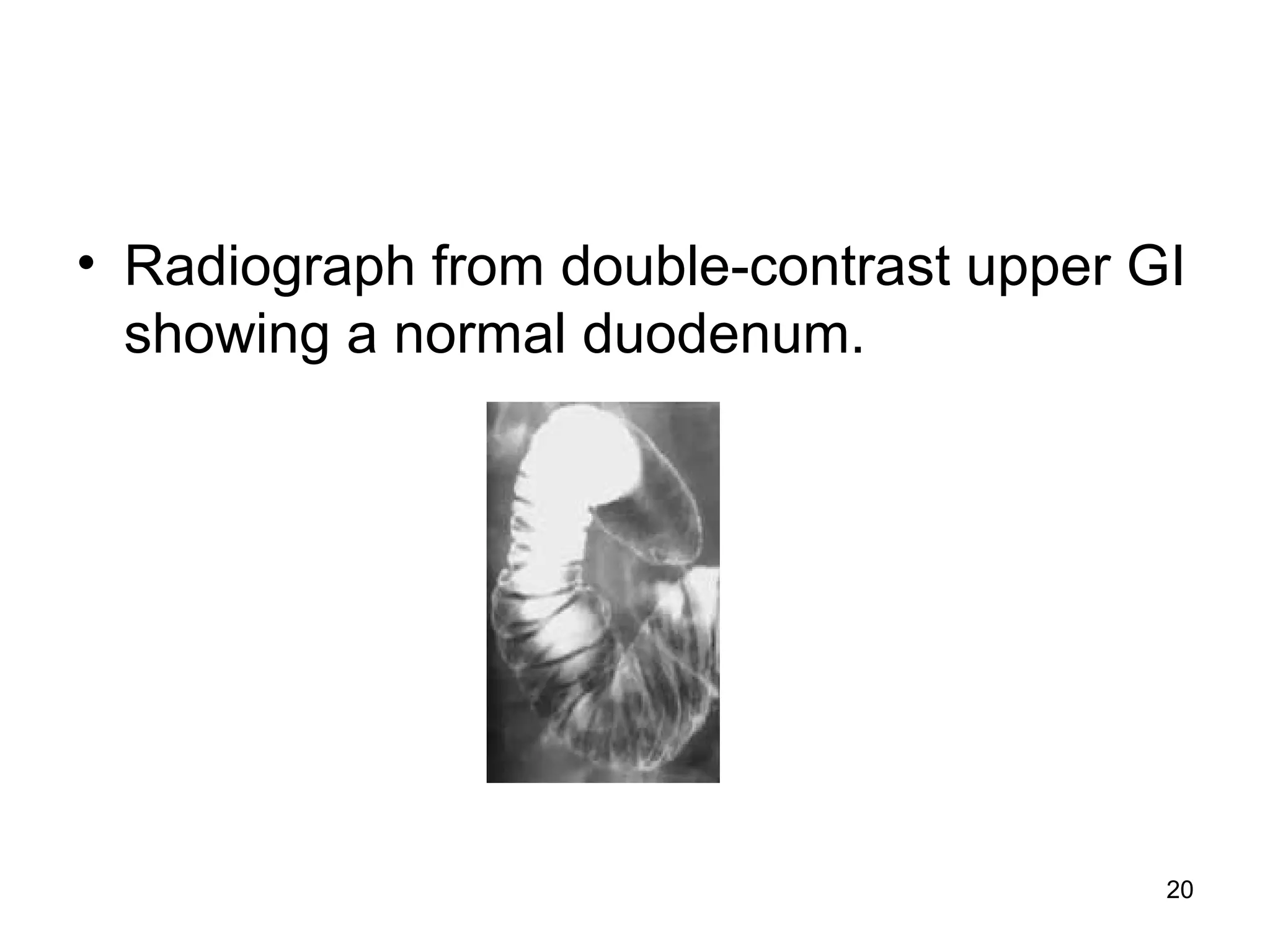 20
• Radiograph from double-contrast upper GI
showing a normal duodenum.
 