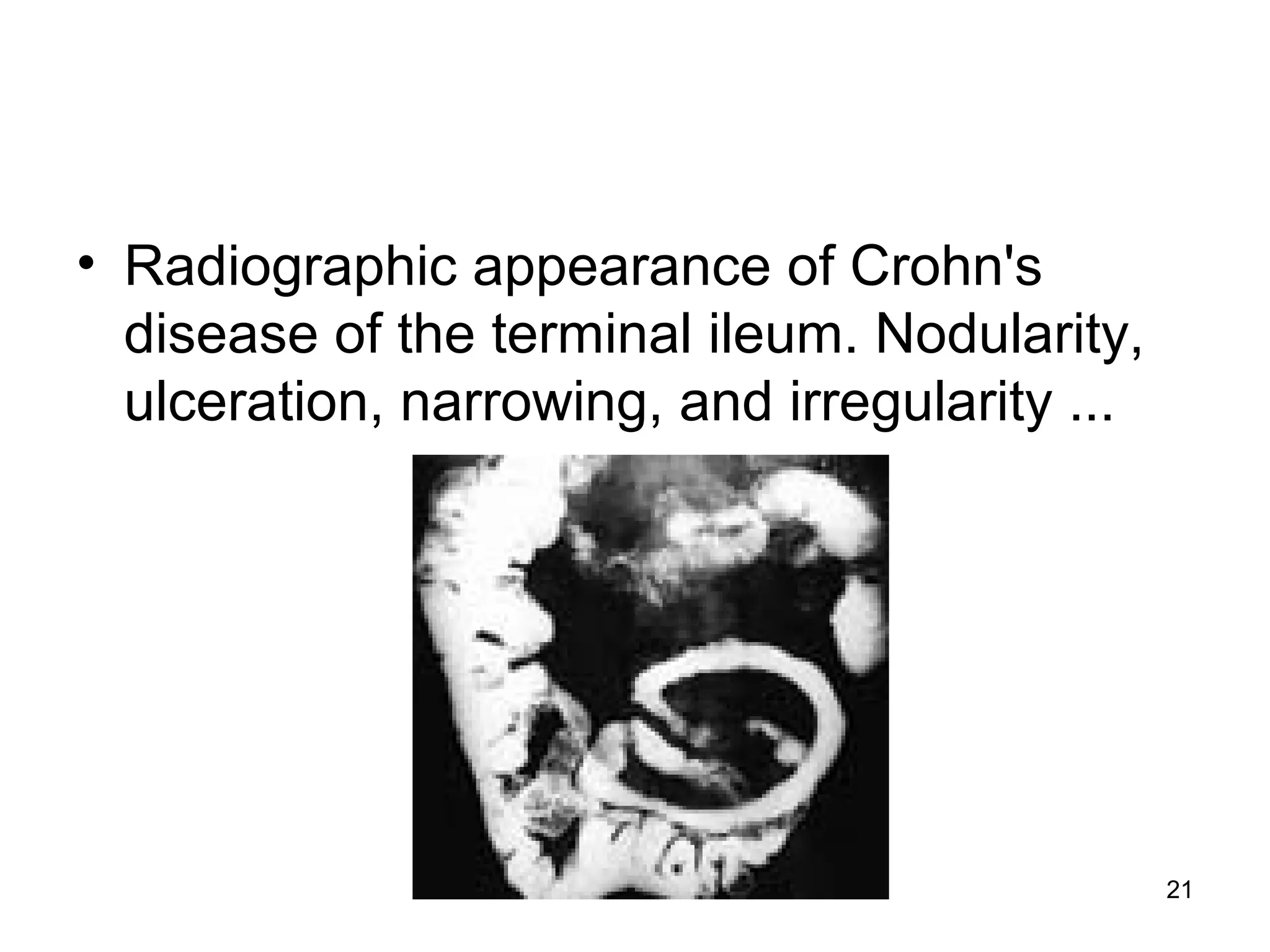 21
• Radiographic appearance of Crohn's
disease of the terminal ileum. Nodularity,
ulceration, narrowing, and irregularity ...
 