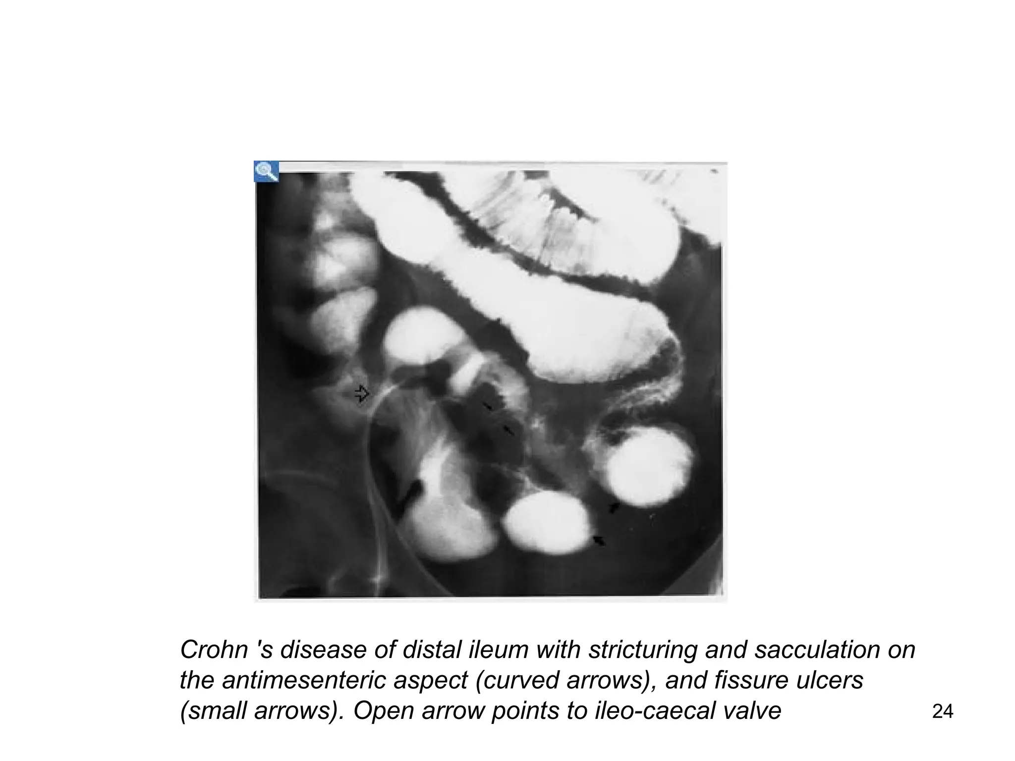 24
Crohn 's disease of distal ileum with stricturing and sacculation on
the antimesenteric aspect (curved arrows), and fissure ulcers
(small arrows). Open arrow points to ileo-caecal valve
 