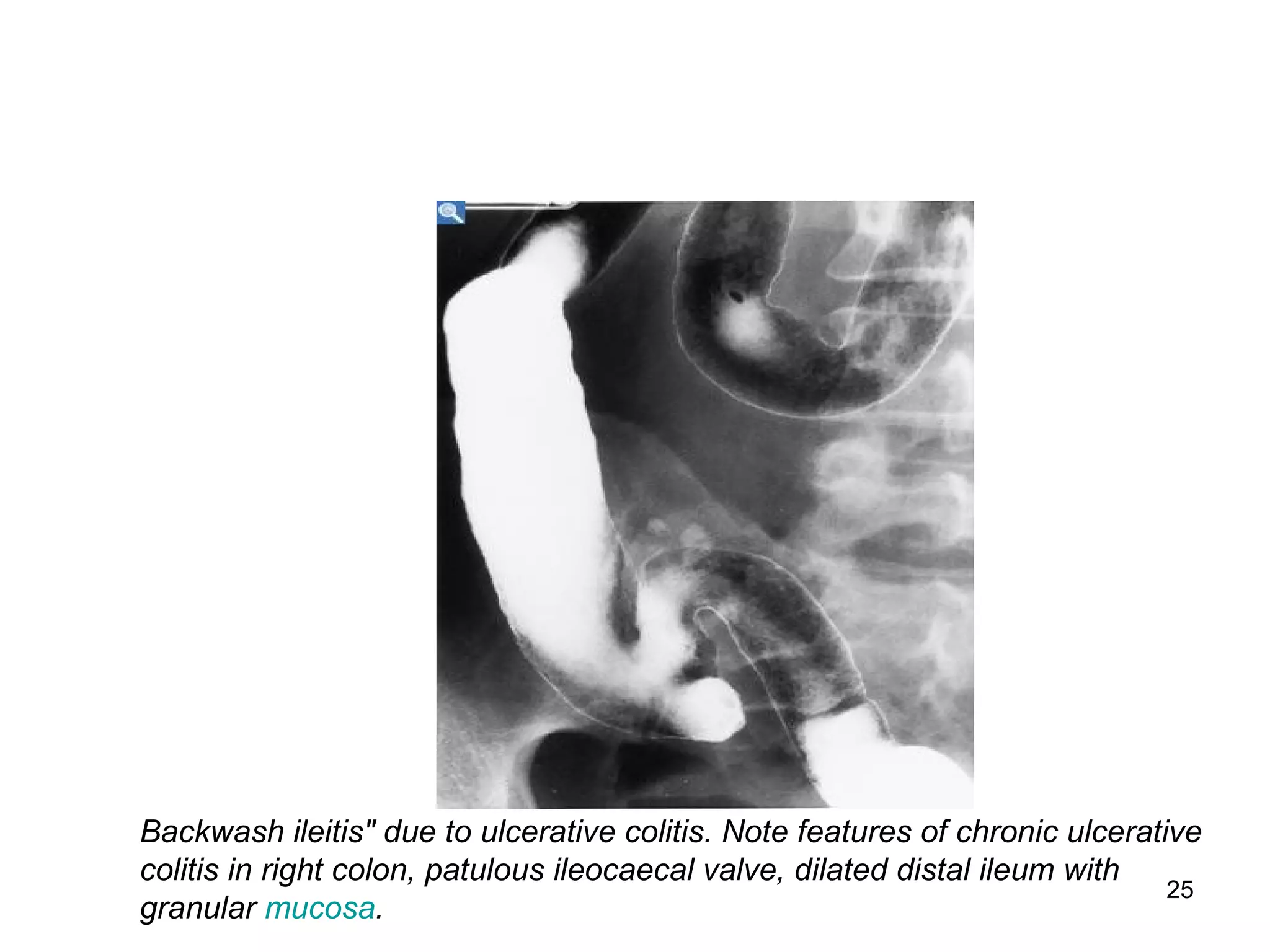 25
Backwash ileitis" due to ulcerative colitis. Note features of chronic ulcerative
colitis in right colon, patulous ileocaecal valve, dilated distal ileum with
granular mucosa.
 