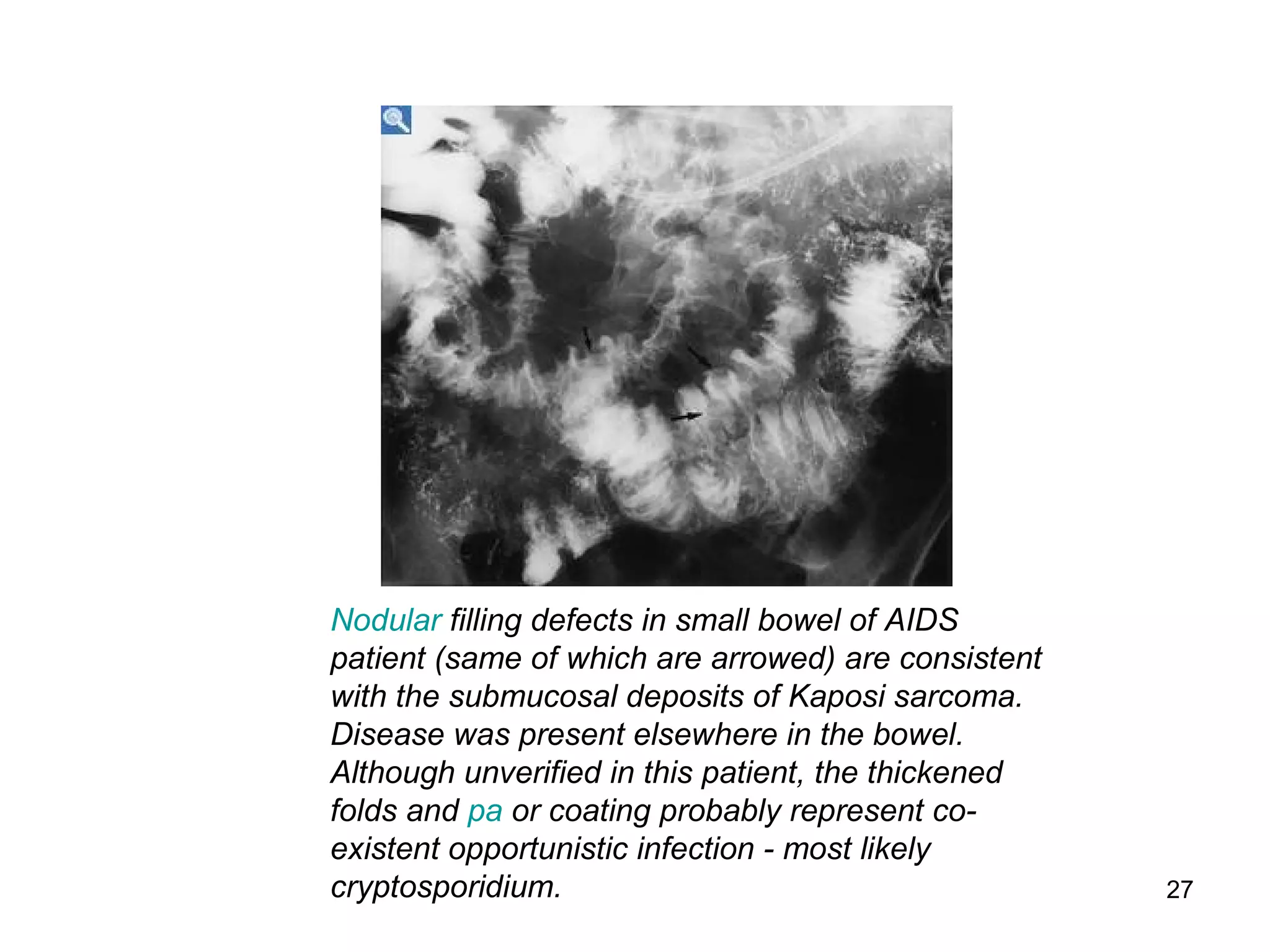 27
Nodular filling defects in small bowel of AIDS
patient (same of which are arrowed) are consistent
with the submucosal deposits of Kaposi sarcoma.
Disease was present elsewhere in the bowel.
Although unverified in this patient, the thickened
folds and pa or coating probably represent co-
existent opportunistic infection - most likely
cryptosporidium.
 