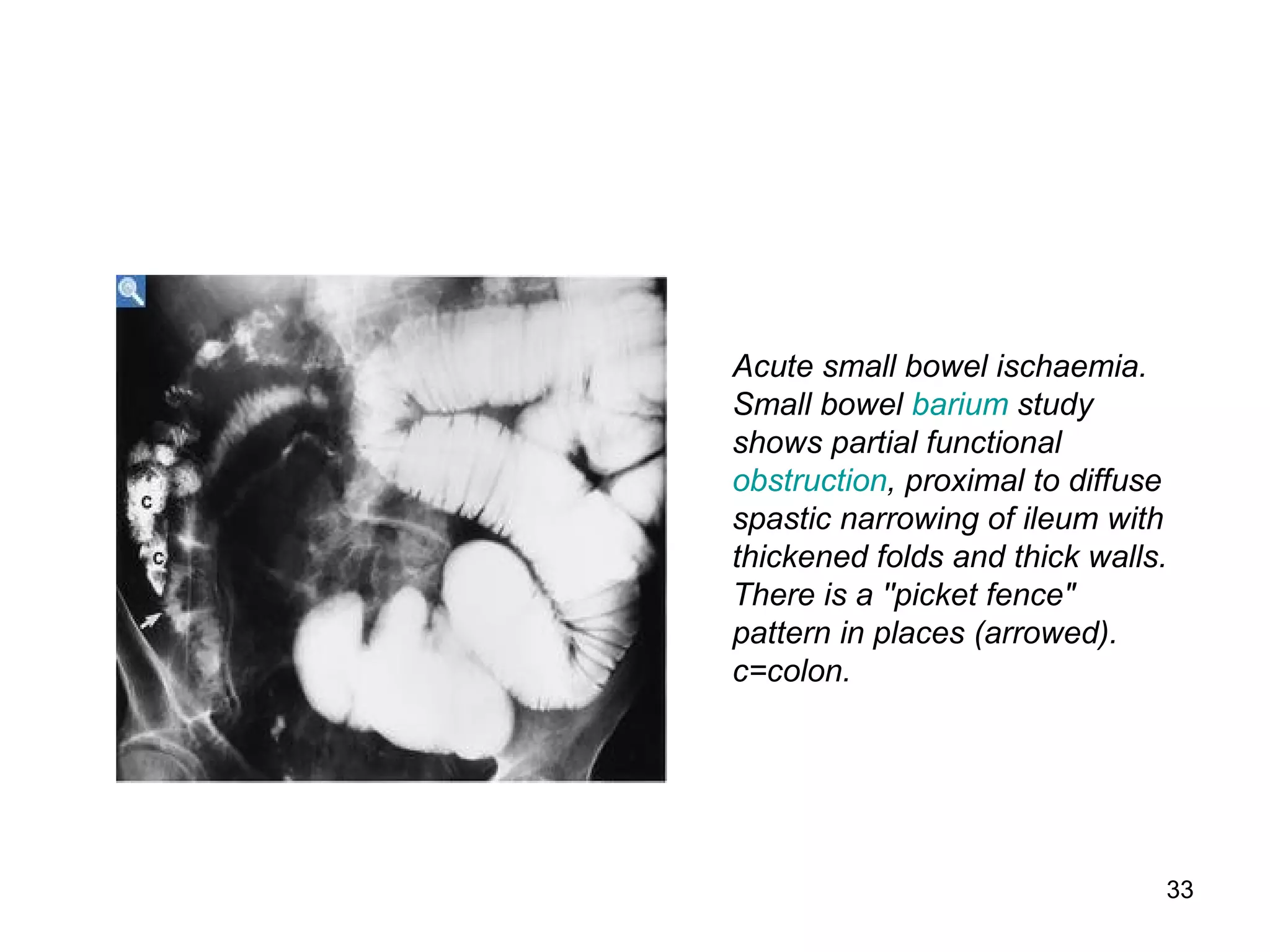 33
Acute small bowel ischaemia.
Small bowel barium study
shows partial functional
obstruction, proximal to diffuse
spastic narrowing of ileum with
thickened folds and thick walls.
There is a ''picket fence"
pattern in places (arrowed).
c=colon.
 