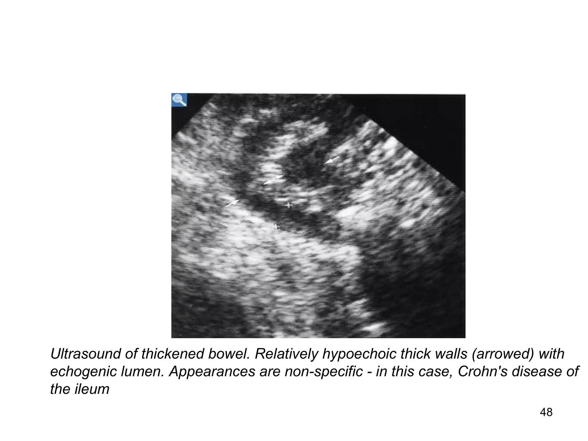 48
Ultrasound of thickened bowel. Relatively hypoechoic thick walls (arrowed) with
echogenic lumen. Appearances are non-specific - in this case, Crohn's disease of
the ileum
 