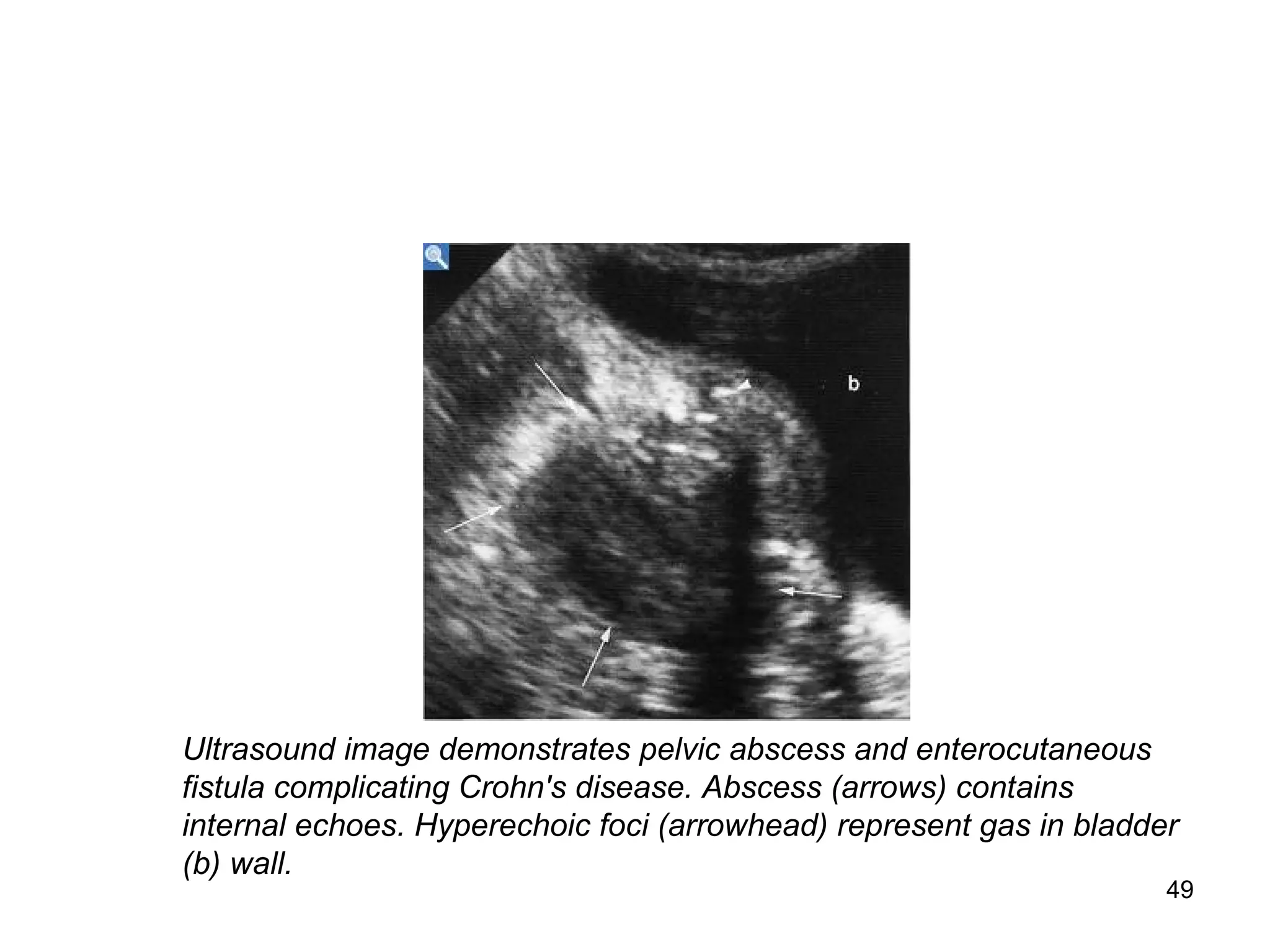 49
Ultrasound image demonstrates pelvic abscess and enterocutaneous
fistula complicating Crohn's disease. Abscess (arrows) contains
internal echoes. Hyperechoic foci (arrowhead) represent gas in bladder
(b) wall.
 