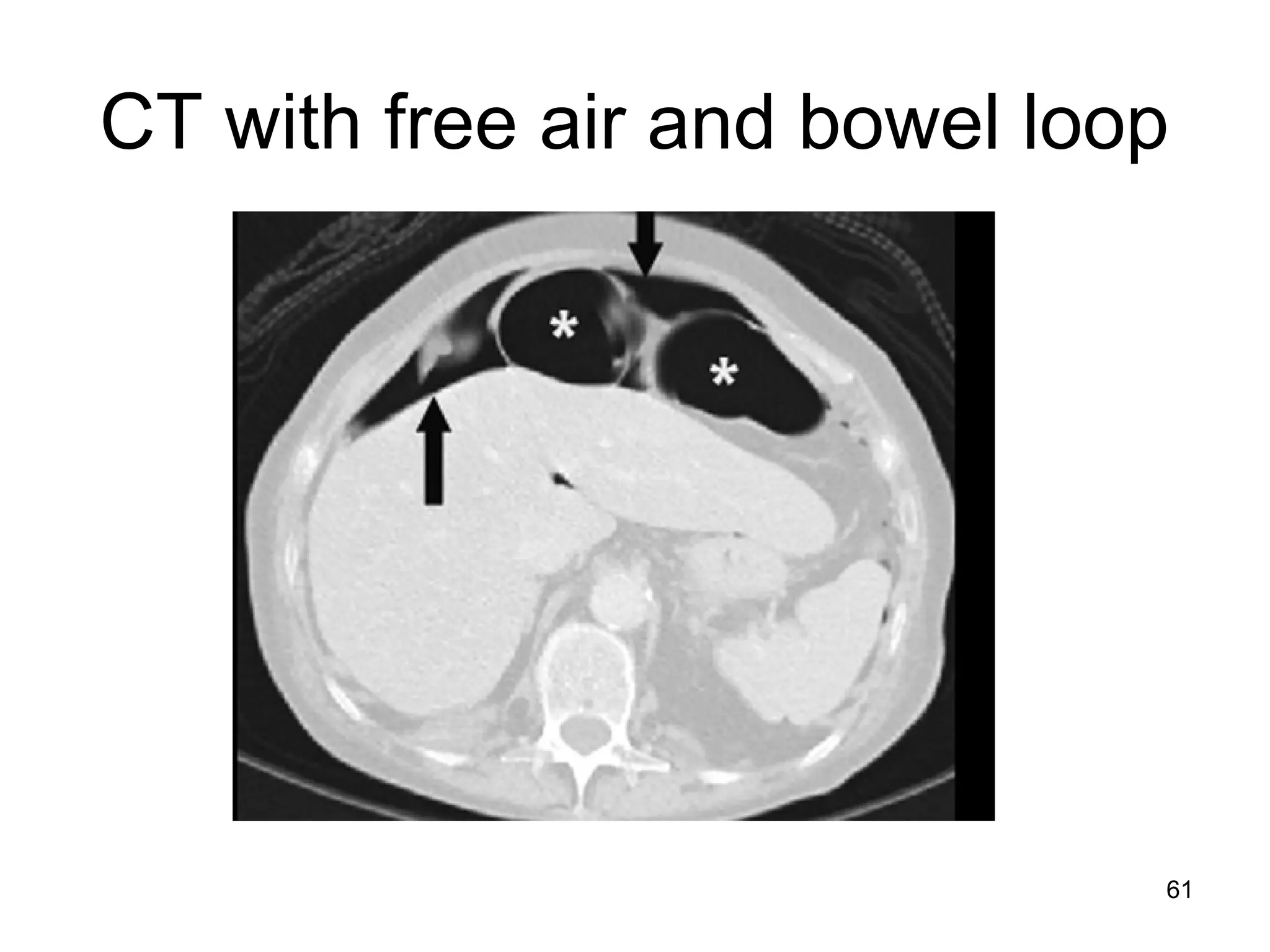 61
CT with free air and bowel loop
 
