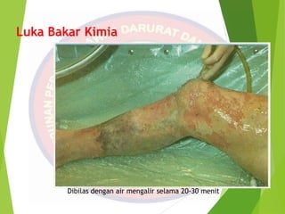 Luka Bakar Kimia
Dibilas dengan air mengalir selama 20-30 menit
 