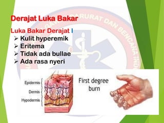 Derajat Luka Bakar
Luka Bakar Derajat I
 Kulit hyperemik
 Eritema
 Tidak ada bullae
 Ada rasa nyeri
 