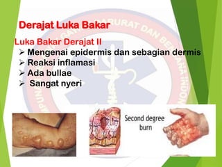 Derajat Luka Bakar
Luka Bakar Derajat II
 Mengenai epidermis dan sebagian dermis
 Reaksi inflamasi
 Ada bullae
 Sangat nyeri
 