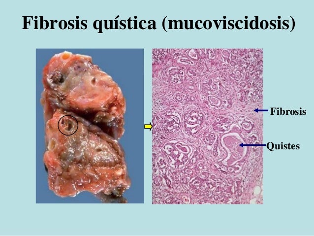 Resultado de imagen para higado fibrosis quistica