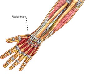 Radial artery
 