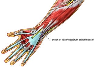 Tendon of flexor digitorum superficialis m.
 
