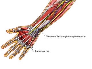 Tendon of flexor digitorum profundus m.
Lumbrical ms.
 