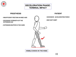 10
DECELERATION PHASE:
TERMINAL IMPACT
- INSUFFICIENT FRICTION IN KNEE AXIS
- EXCESSIVE STRENGTH OF THE
EXTENSION AID
- EXTENSION BUFFER IS TOO HARD
PROSTHESIS
- EXCESSIVE ACCELERATION FORCE
- BAD GAIT HABIT
PATIENT
VISIBLE SHOCK IN THE KNEE
 
