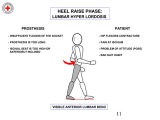 11
HEEL RAISE PHASE:
LUMBAR HYPER LORDOSIS
- INSUFFICIENT FLEXION OF THE SOCKET
- PROSTHESIS IS TOO LONG
- ISCHIAL SEAT IS TOO HIGH OR
ANTERIORLY INCLINED
PROSTHESIS
- HIP FLEXORS CONTRACTURE
- PAIN AT ISCHIUM
- PROBLEM OF ATTITUDE (POSE)
- BAD GAIT HABIT
PATIENT
VISIBLE ANTERIOR LUMBAR BEND
 