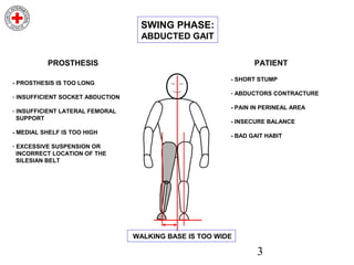 3
- PROSTHESIS IS TOO LONG
- INSUFFICIENT SOCKET ABDUCTION
- INSUFFICIENT LATERAL FEMORAL
SUPPORT
- MEDIAL SHELF IS TOO HIGH
- EXCESSIVE SUSPENSION OR
INCORRECT LOCATION OF THE
SILESIAN BELT
PROSTHESIS
- SHORT STUMP
- ABDUCTORS CONTRACTURE
- PAIN IN PERINEAL AREA
- INSECURE BALANCE
- BAD GAIT HABIT
PATIENT
WALKING BASE IS TOO WIDE
SWING PHASE:
ABDUCTED GAIT
 