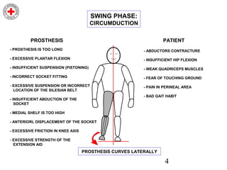4
- PROSTHESIS IS TOO LONG
- EXCESSIVE PLANTAR FLEXION
- INSUFFICIENT SUSPENSION (PISTONING)
- INCORRECT SOCKET FITTING
- EXCESSIVE SUSPENSION OR INCORRECT
LOCATION OF THE SILESIAN BELT
- INSUFFICIENT ABDUCTION OF THE
SOCKET
- MEDIAL SHELF IS TOO HIGH
- ANTERIORL DISPLACEMENT OF THE SOCKET
- EXCESSIVE FRICTION IN KNEE AXIS
- EXCESSIVE STRENGTH OF THE
EXTENSION AID
PROSTHESIS
- ABDUCTORS CONTRACTURE
- INSUFFICIENT HIP FLEXION
- WEAK QUADRICEPS MUSCLES
- FEAR OF TOUCHING GROUND
- PAIN IN PERINEAL AREA
- BAD GAIT HABIT
PATIENT
PROSTHESIS CURVES LATERALLY
SWING PHASE:
CIRCUMDUCTION
 