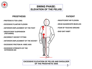5
- PROTESIS IS TOO LONG
- EXCESSIVE PLANTAR FLEXION
- ANTERIOR DISPLACEMENT OF THE FOOT
- INSUFFICIENT SUSPENSION
(PISTONING)
- INCORRECT SOCKET FITTING
- ANTERIOR DISPLACEMENT OF THE SOCKET
- EXCESSIVE FRICTION IN KNEE AXIS
- EXCESSIVE STRENGTH OF THE
EXTENSION AID
PROSTHESIS
- INSUFFICIENT HIP FLEXION
- WEAK QUADRICEPS MUSCLES
- FEAR OF TOUCHIG GROUND
- BAD GAIT HABIT
PATIENT
EXCESSIVE ELEVATION OF PELVIS AND SHOULDER
OF THE PROSTHETIC SIDE
SWING PHASE:
ELEVATION OF THE PELVIS
 